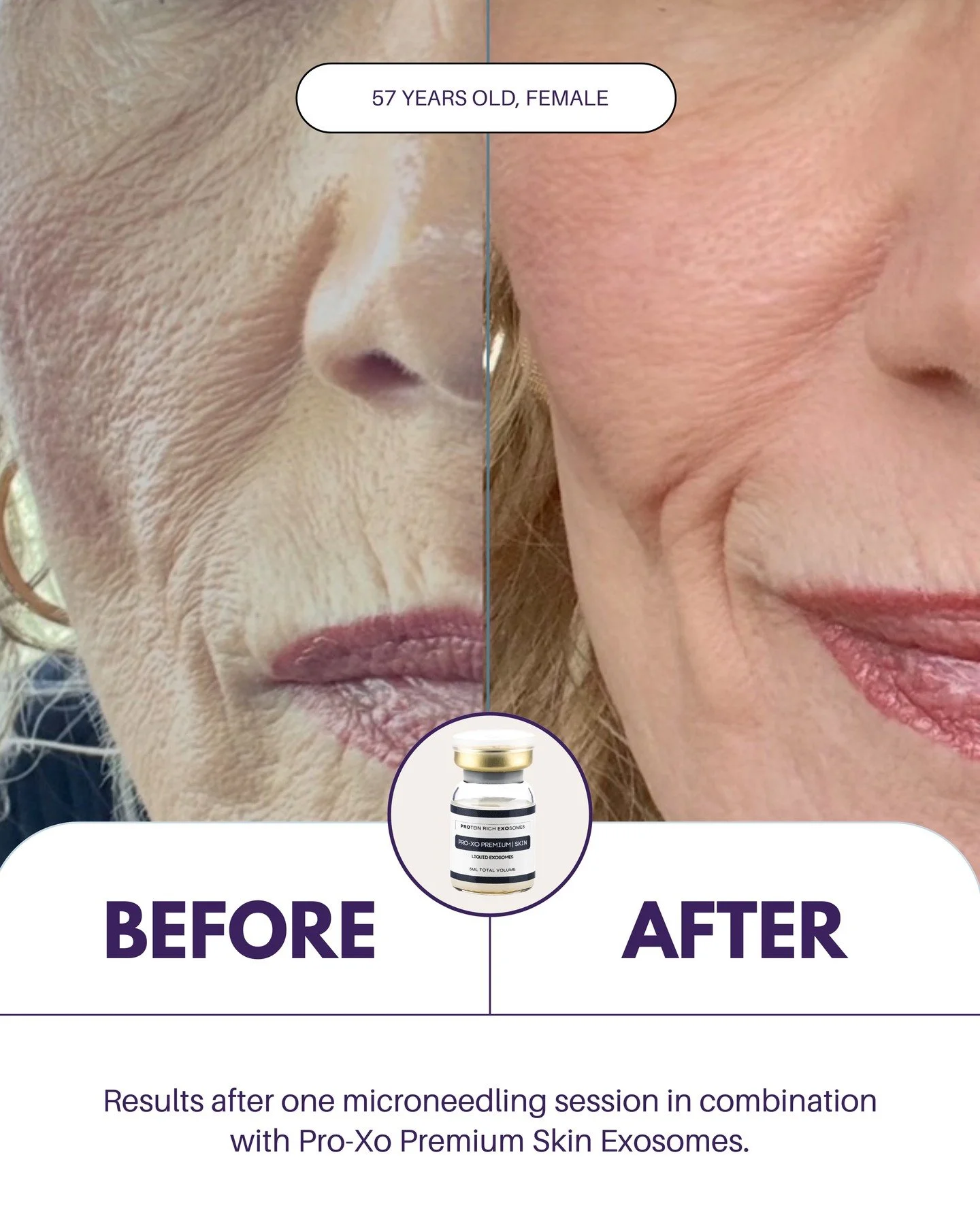 Just one microneedling session paired with Pro-Xo Premium Skin Exosomes delivered these incredible results! Smoother texture, refined tone, and visibly rejuvenated skin. 

"We love Pro-Xo products and so do our clients! The Pro-Xo Skin products 