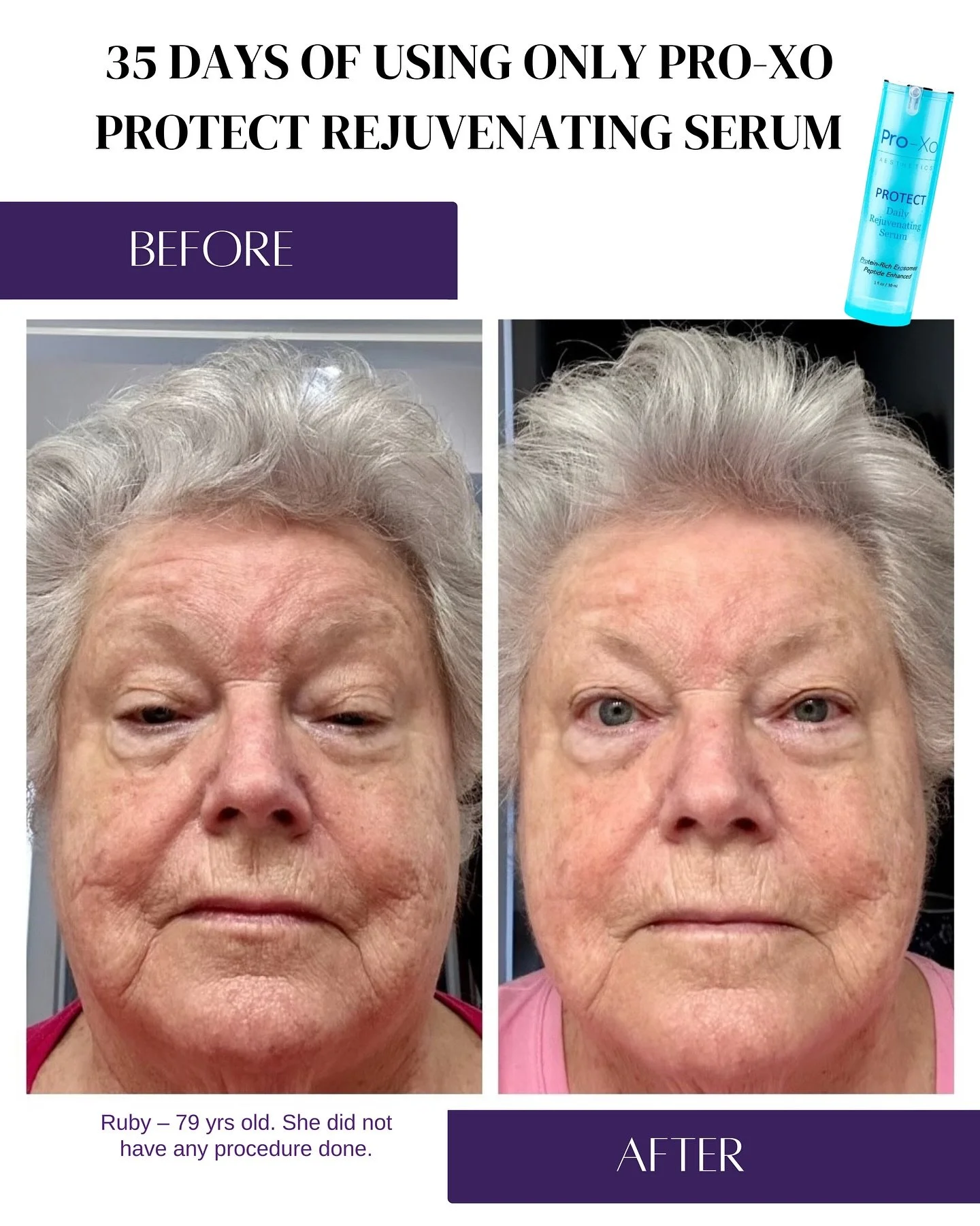 ✨ Real Results. No Filters. No Procedures. ✨
Ruby, 79, used only Pro-Xo Protect for 35 days&mdash;no treatments, just daily application of our rejuvenating serum. Her glow says it all.

&ldquo;After only 30 days of using this product, I can&rsquo;t l