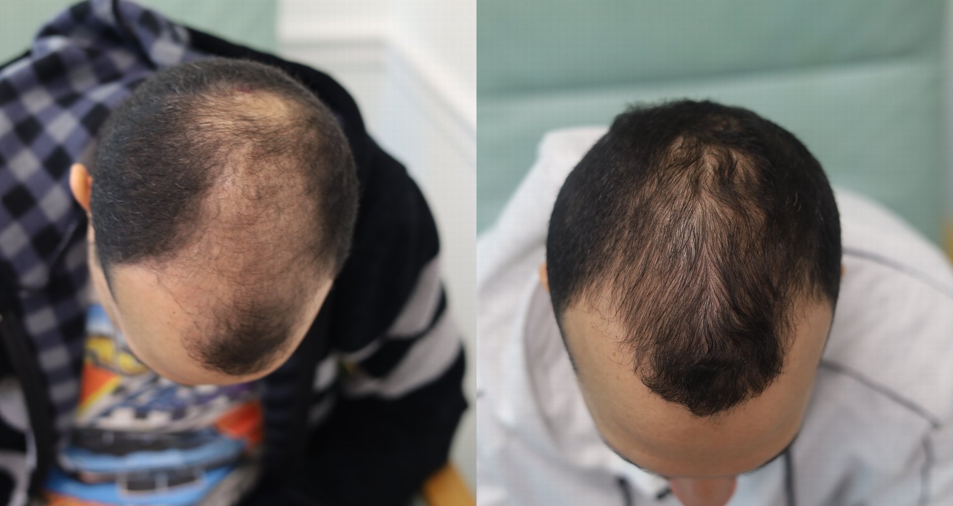 Male, 1 Juvasonic Tx with Pro-Xo Exosomes with Copper Peptides, 4 months post