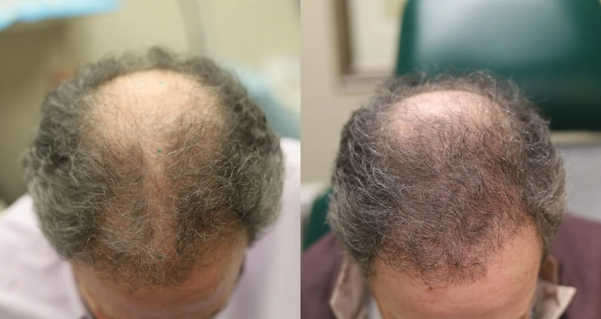 Male, 1 Juvasonic Tx with Pro-Xo Exosomes with Copper Peptides, 4 months post