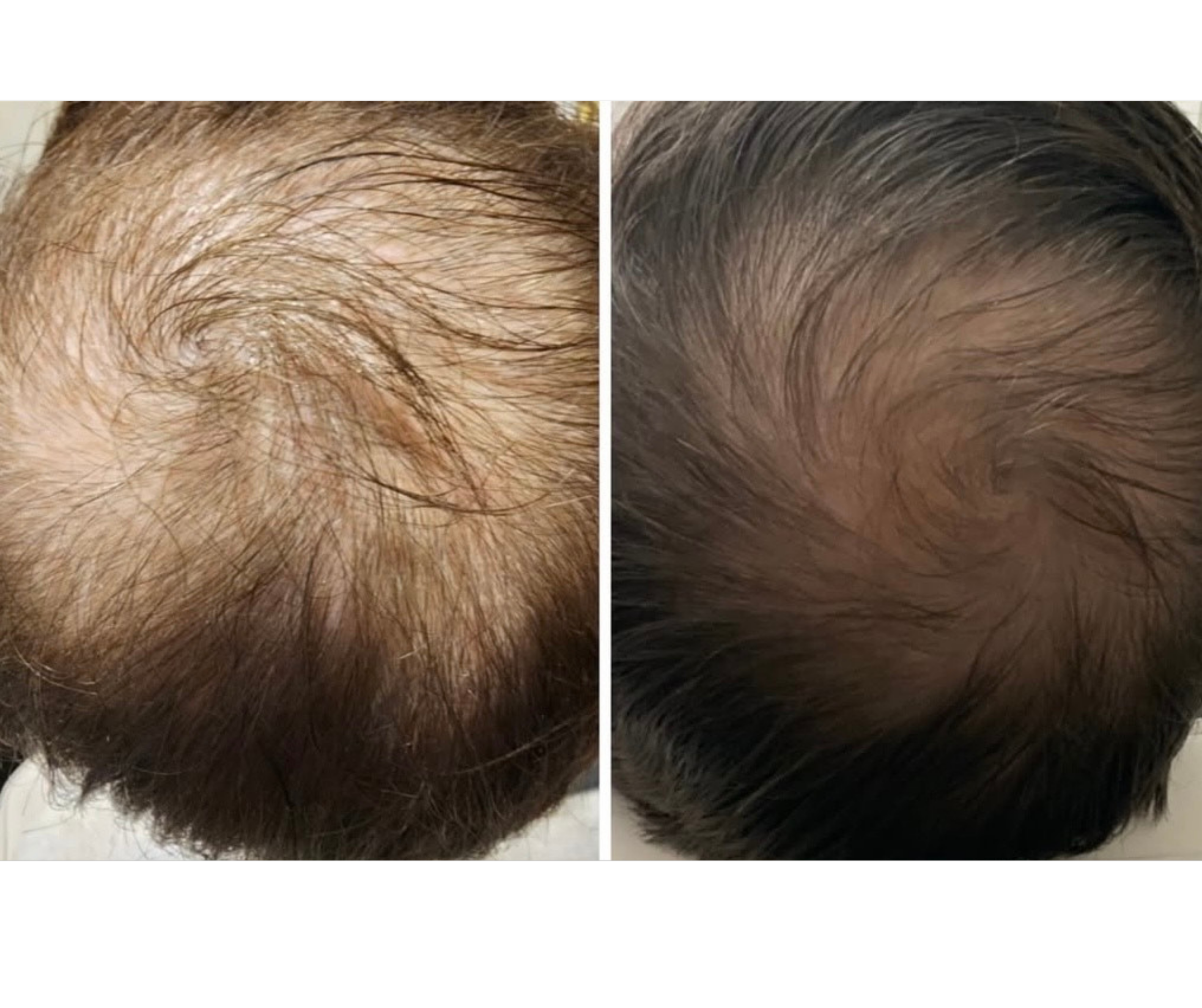 Male 35, Post 1 Juvasonic Tx with Pro-Xo Premium Hair Exosomes