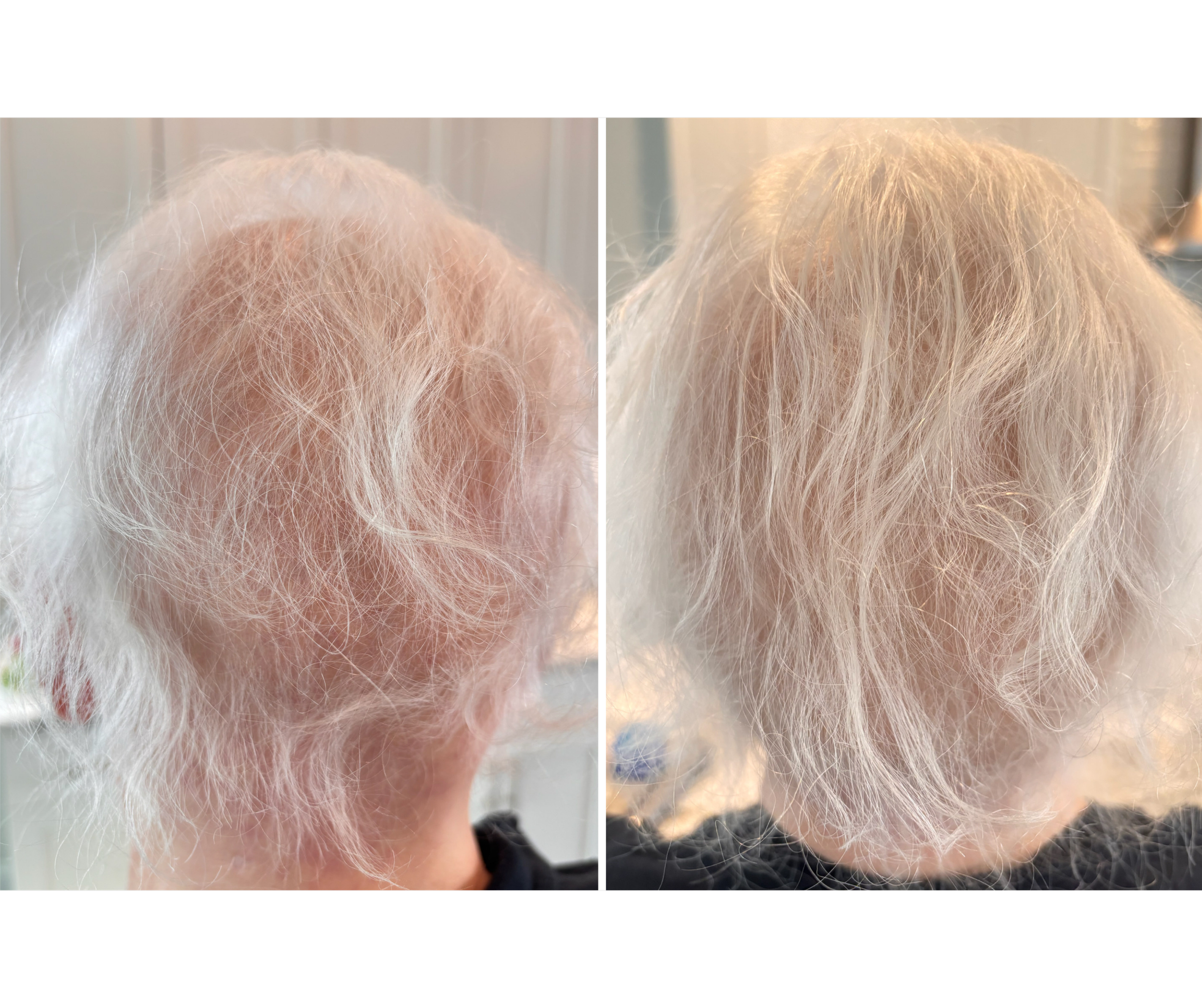 Female 63, 4 weeks Post 1 Juvasonic Tx with Pro-Xo Premium Hair Exosomes