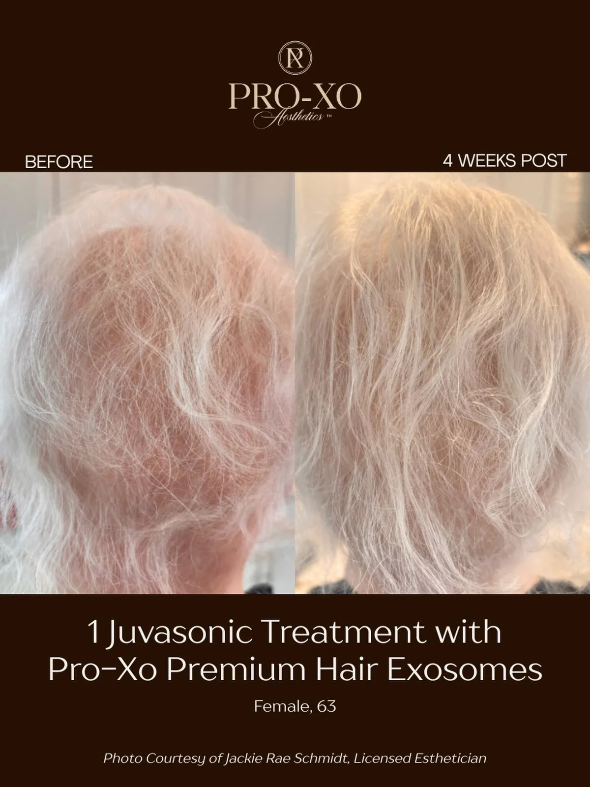 A powerful pairing designed to support a healthier-looking scalp and fuller-looking hair. 

This before &amp; after shows a noticeable improvement in the appearance of hair density and scalp coverage after just 1 Juvasonic treatment with our Premium 