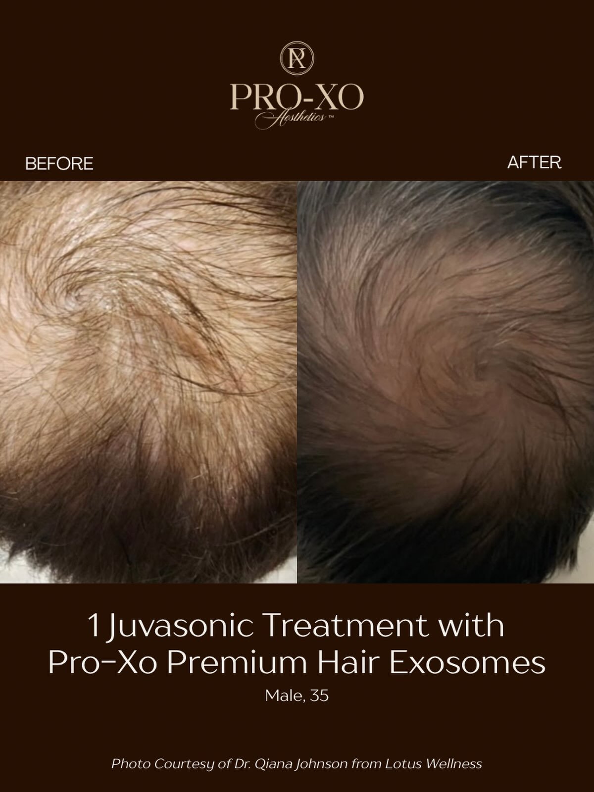 After just 1 treatment of @juvasonic with our Premium Hair Exosomes, this young male saw quite the difference in the fullness of his hair! 

It&rsquo;s never too early to start treatments, and Pro-Xo exosomes are the perfect place to start ✨

#exosom