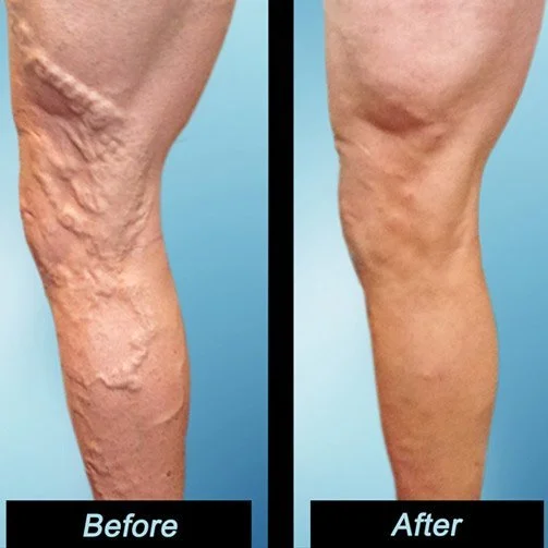Varicose-Veins-Before-and-After-Vein-Treatment-Photos-in-Tampa.jpg