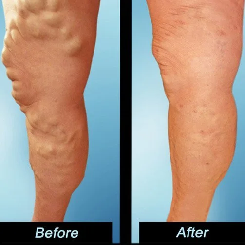 Tampa-Varicose-Vein-Removal-Patient-Pictures.jpg