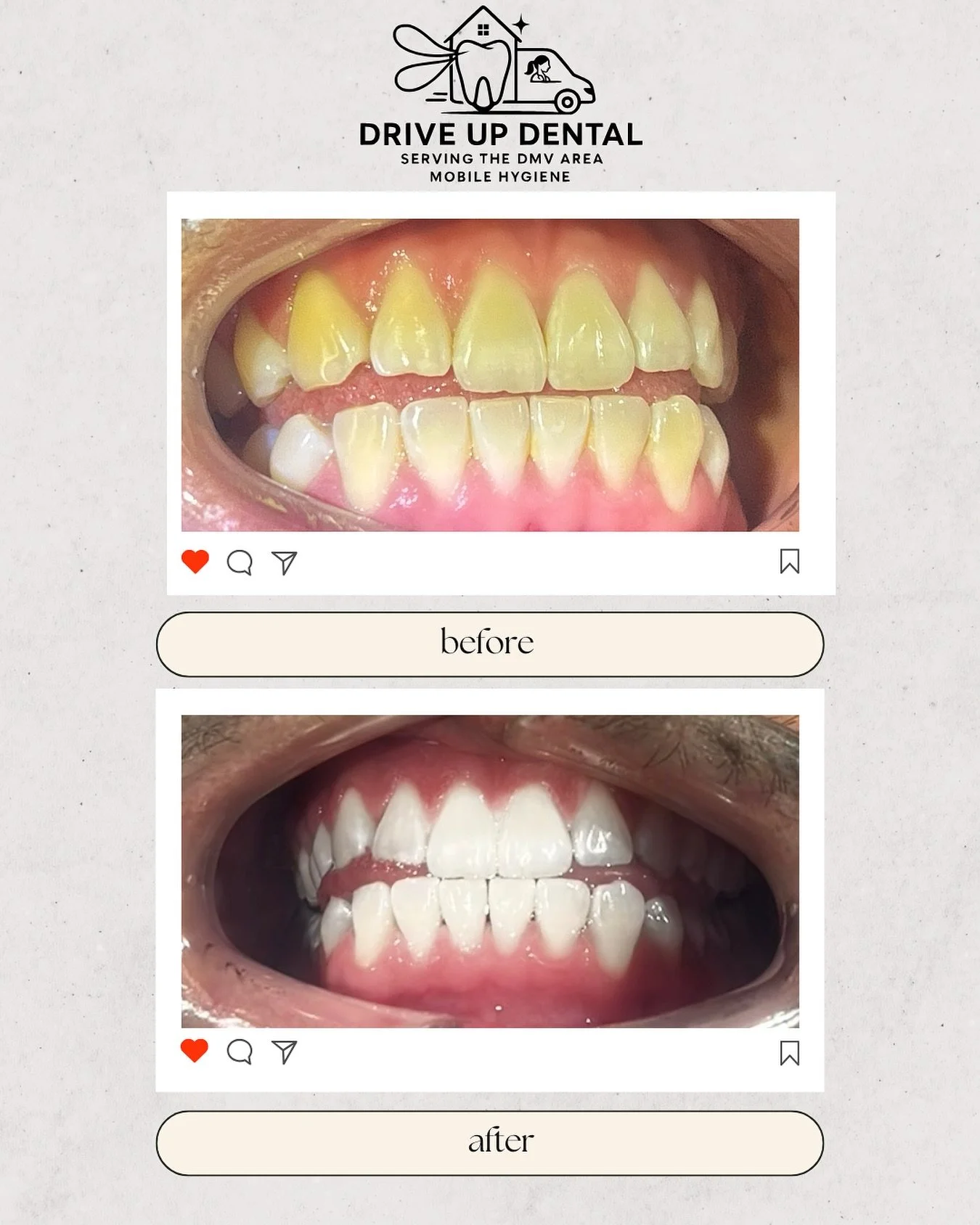 ✨ One session = one glow-up. 
This client left with a brighter, whiter smile in under two hours &mdash; no sensitivity, no stress. 

Whitening that fits into your day, delivered to you. 

#TeethWhitening #BeforeAndAfter #DMVDentistry #DriveUpDental #
