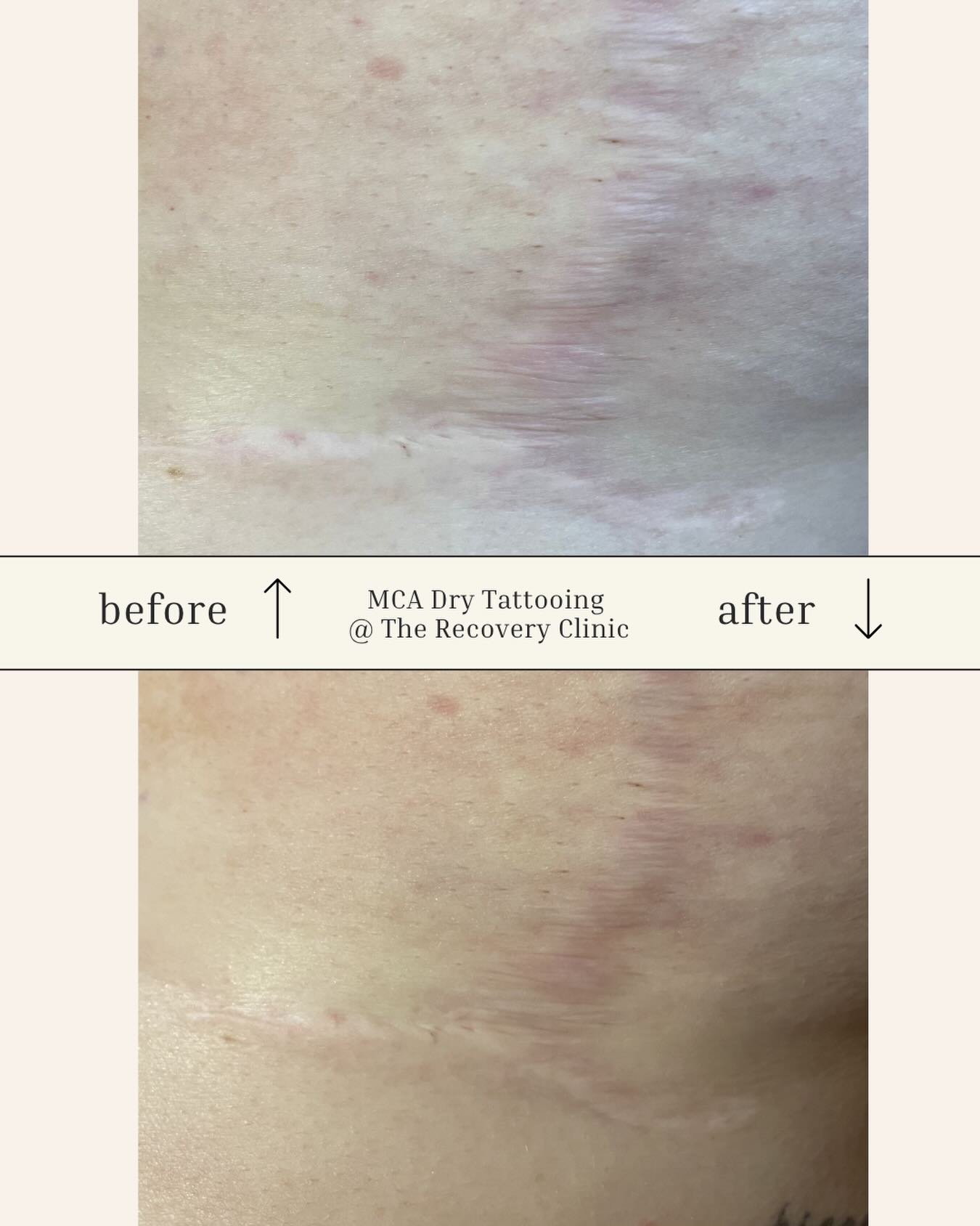 ✨ Before &amp; After: Breast Reduction Scar ✨

These incredible results are after just ONE session of MCA dry tattooing 🙌

While 3&ndash;6 sessions are often recommended for optimal results, many clients are already feeling confident and happy after