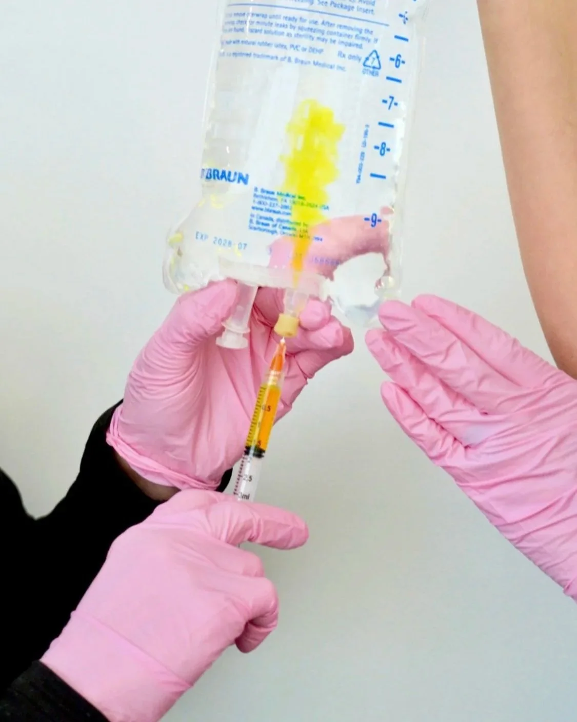 B vitamins added into IV infusion for energy, fatigue relief, hydration in Stark County, Ohio.