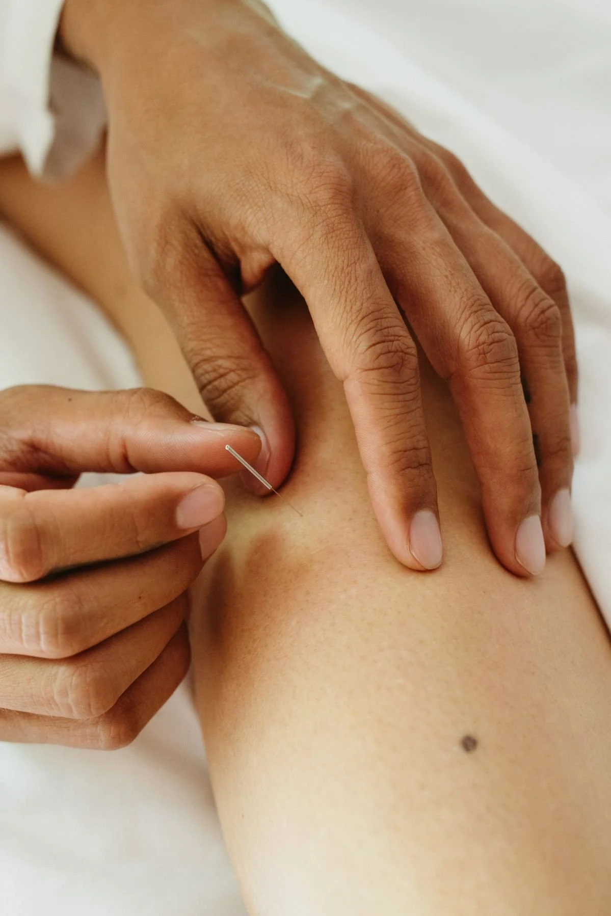 Close-up of a person receiving acupuncture with a thin needle inserted into their arm - acupuncture at Spirit Well Sensory Lounge in Stuart, Florida.