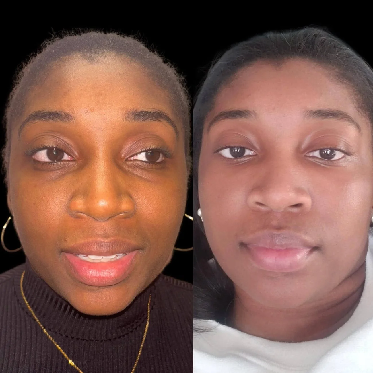 CoolPeel: The Safe, Minimal-Downtime CO2 Laser Treatment for All Skin Types