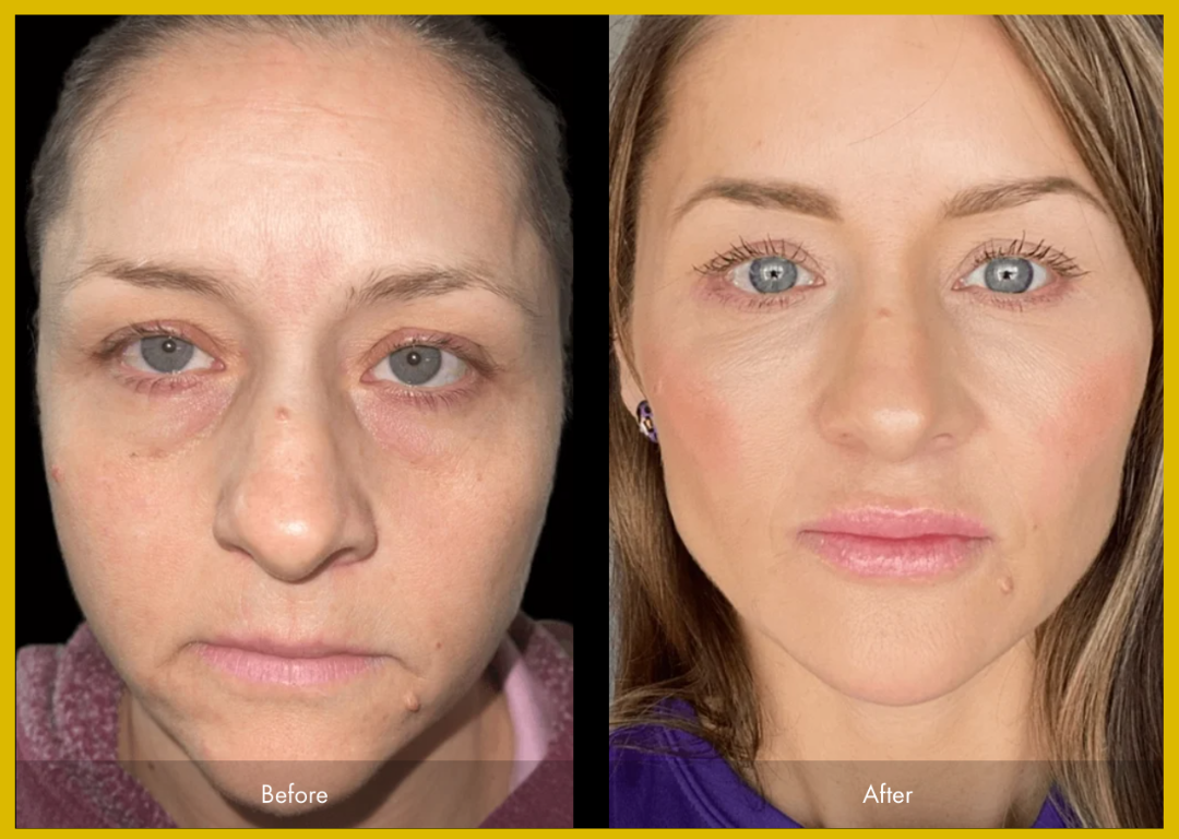 Medspa in Gilbert AZ 85295 l Before and Afters