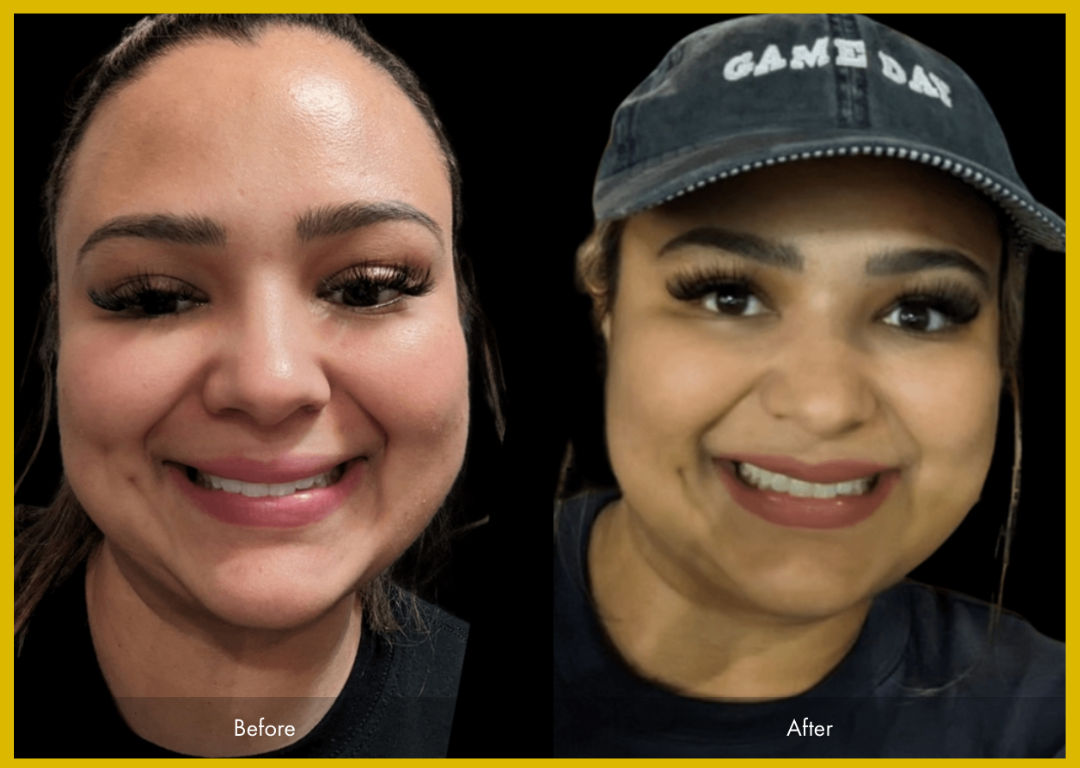 Medspa in Gilbert AZ 85297 l Before and Afters