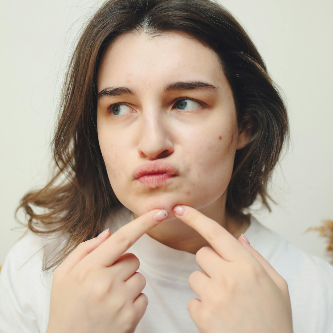 Medspa in Gilbert AZ 85297 l Acne & Scarring Near Me