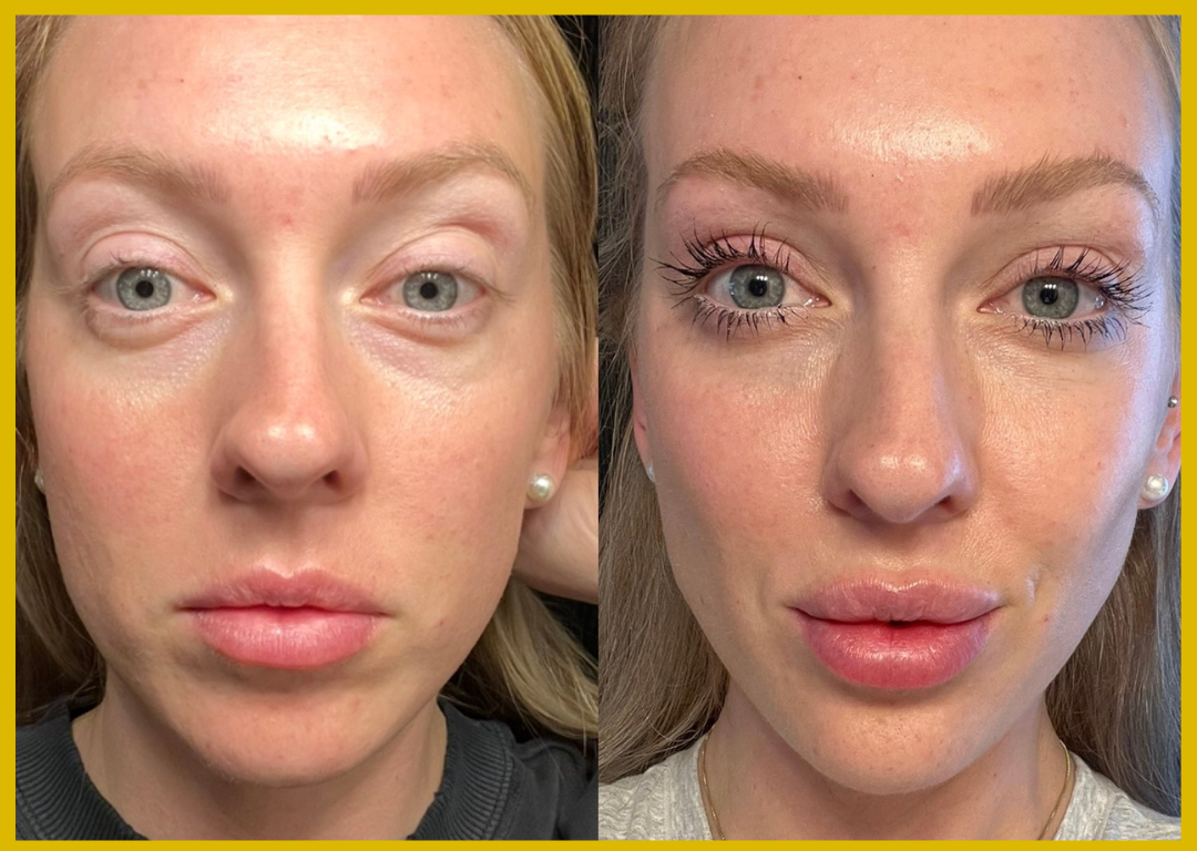 Medspa in Gilbert AZ 85297 l Before and Afters