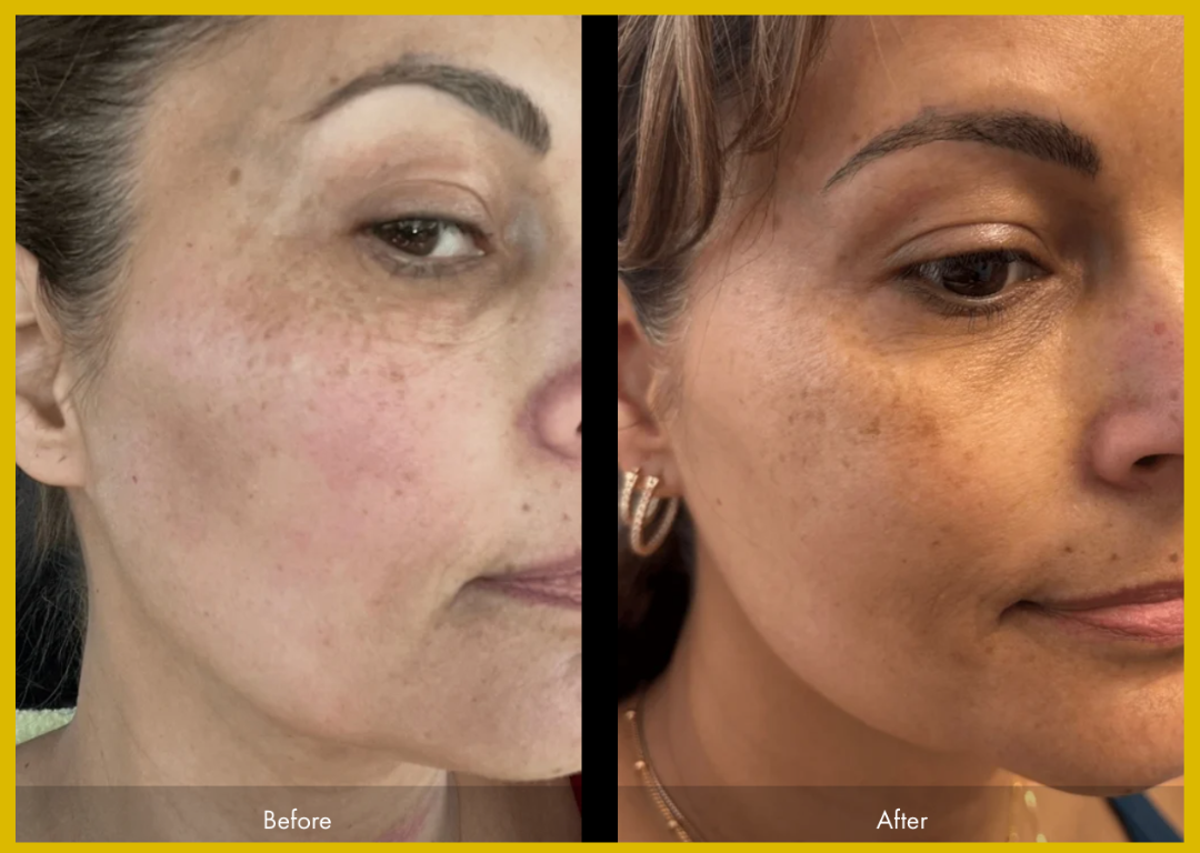 Medspa in Gilbert AZ 85297 l Before and Afters