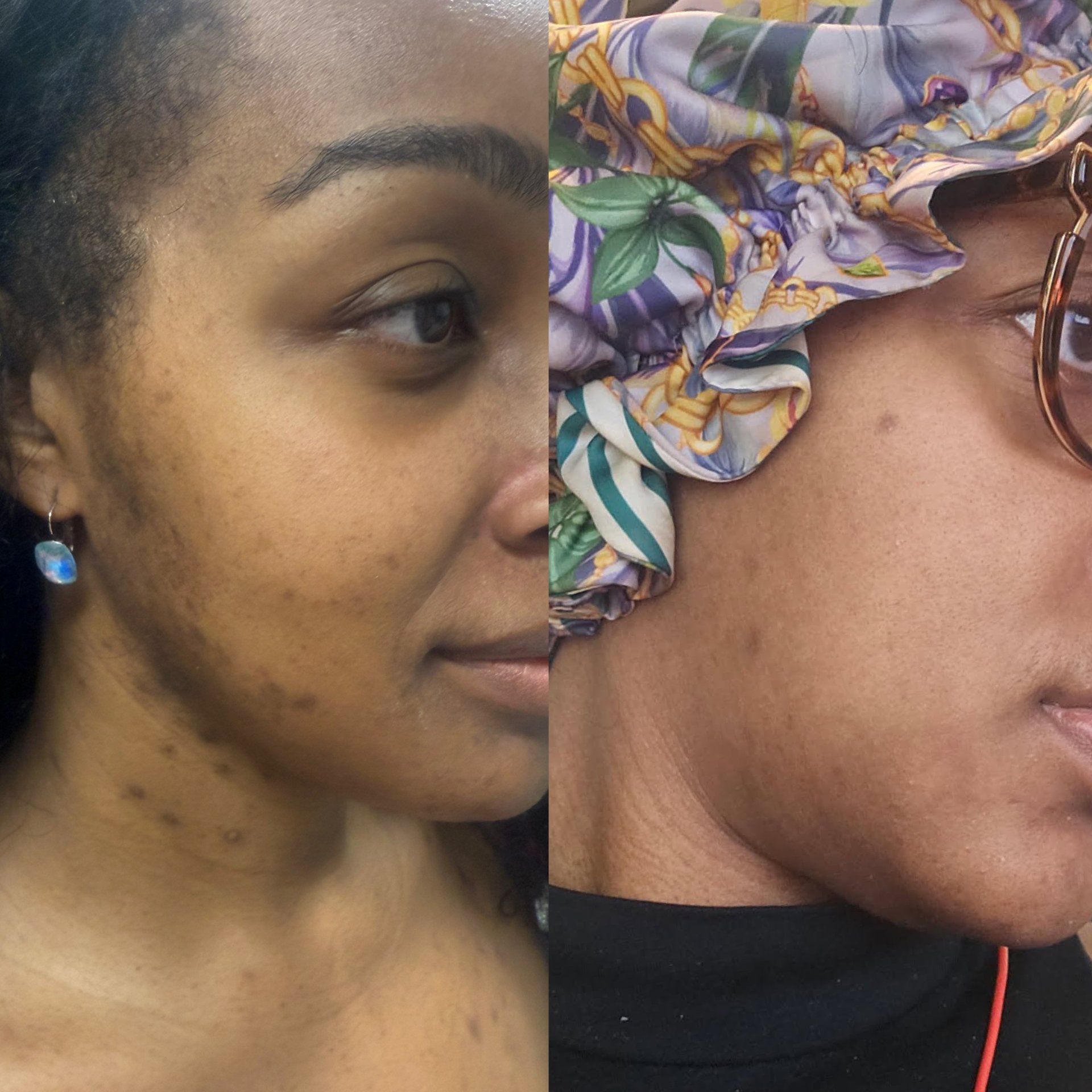 Lighten Up and Fade Away Treatment Laser + Chemical Peel + Cyspera in Gilbert AZ