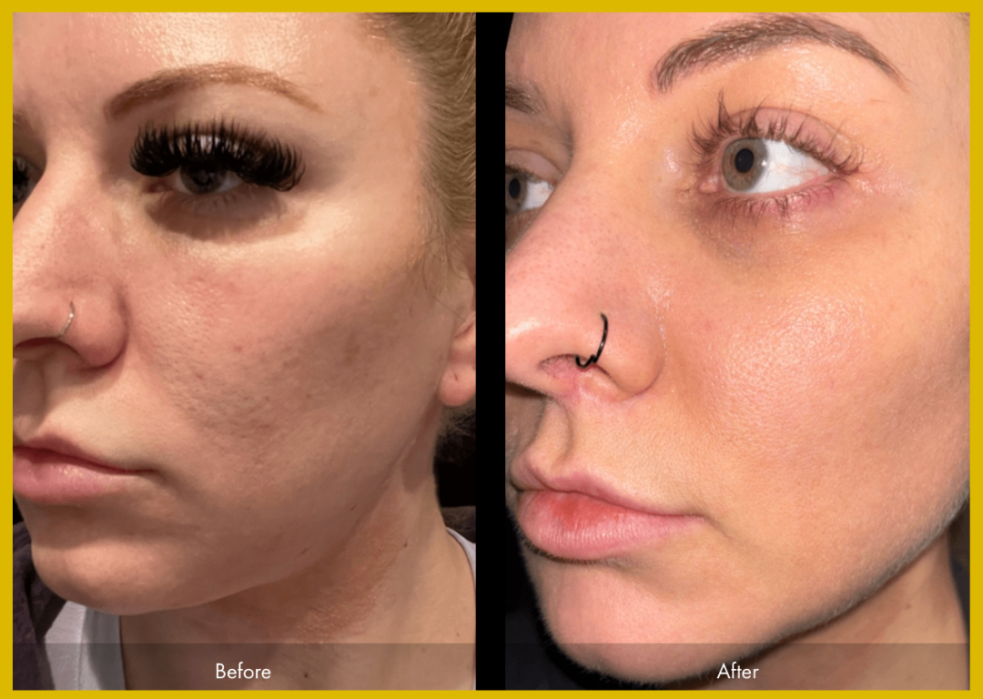 Medspa in Gilbert AZ 85297 l Before and Afters