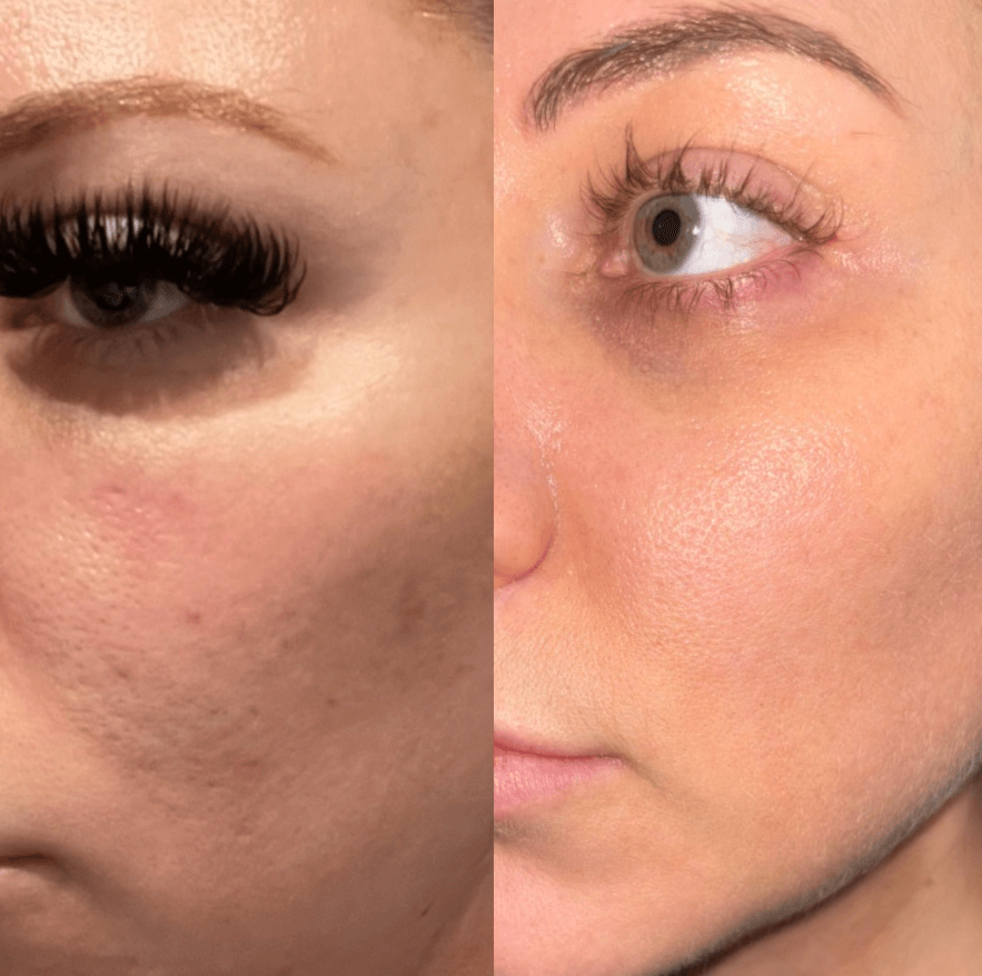 Revitalize Your Skin with the SkinPen Mermaid Facial