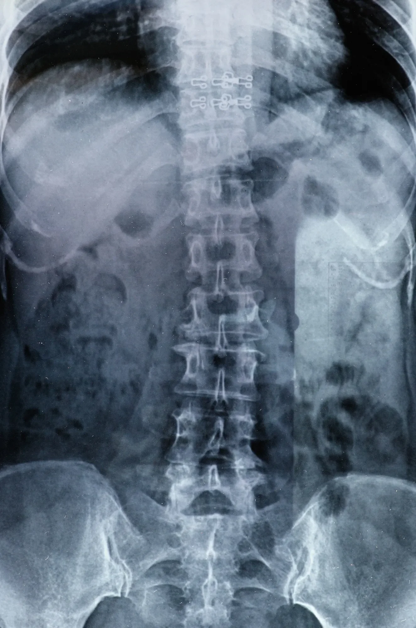 X-ray image of a human pelvis and spine, showing the lumbar vertebrae, pelvis bones, and parts of the legs.