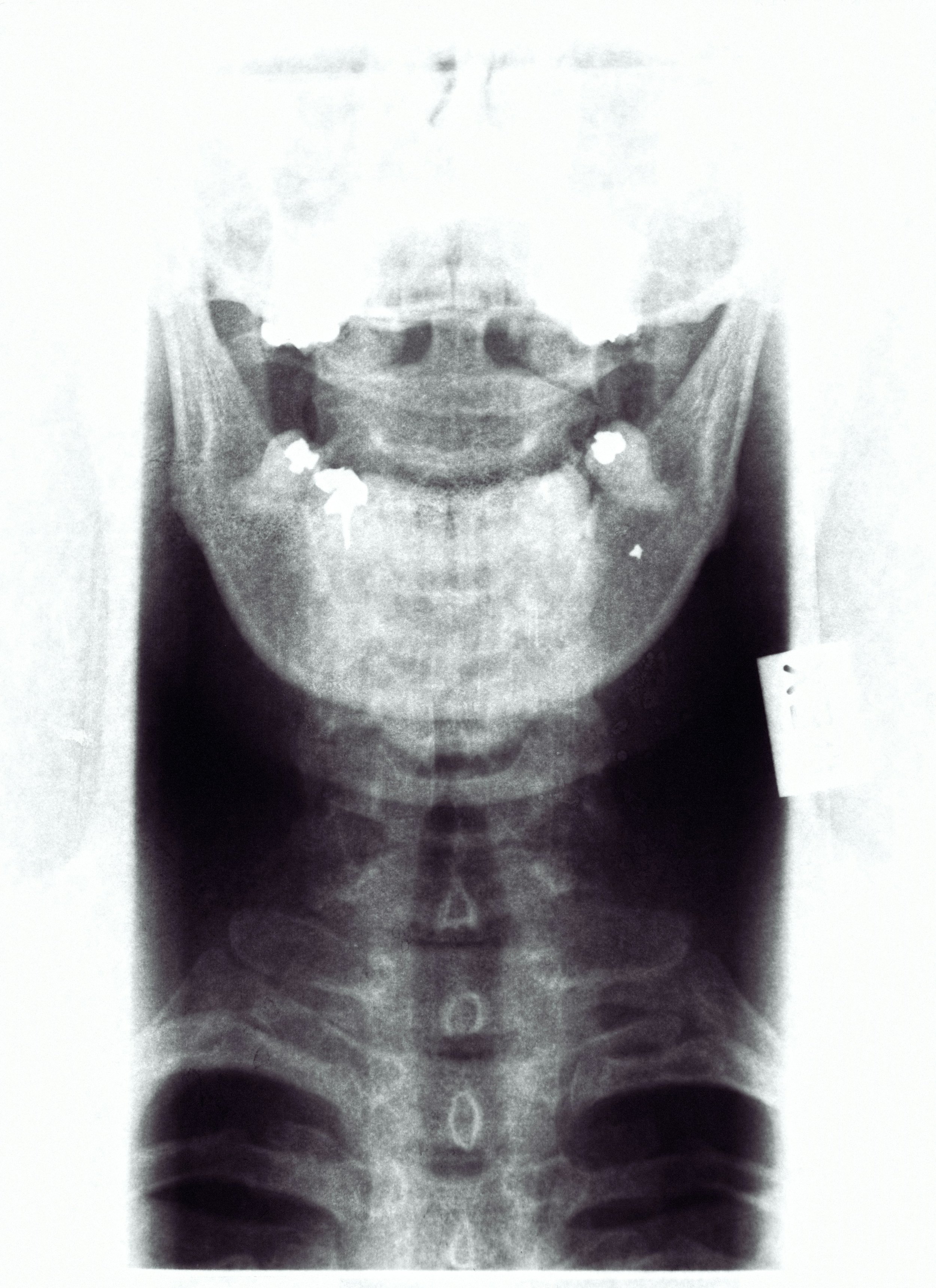 X-ray image of a person's head and neck showing a smile, with dental fillings visible in the teeth.