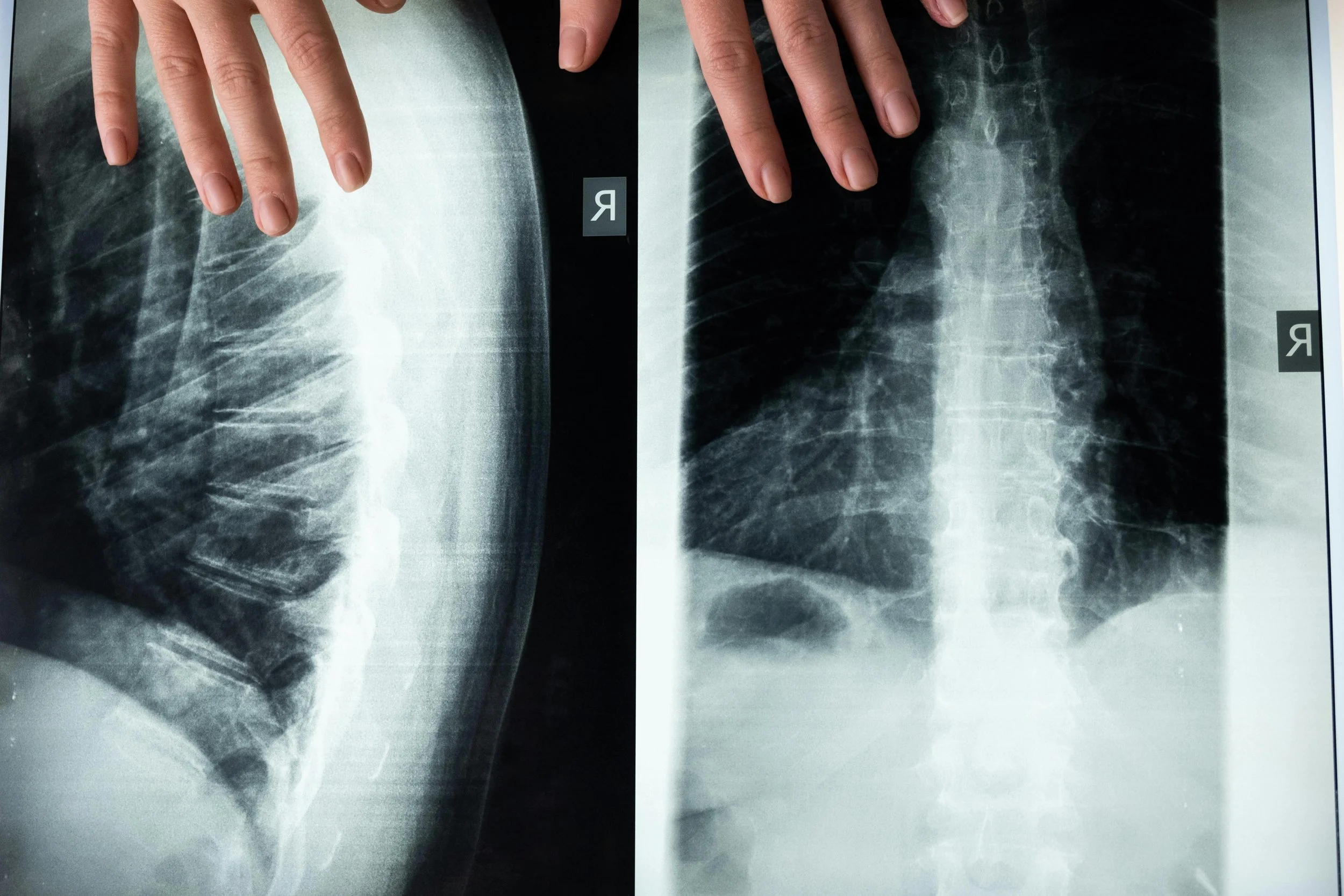 X-ray images of a person's lungs and chest, with a hand resting on the upper chest area in both images.