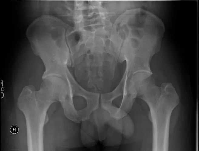 X-ray image of a human pelvis showing bones of the hips, sacrum, and upper femurs.