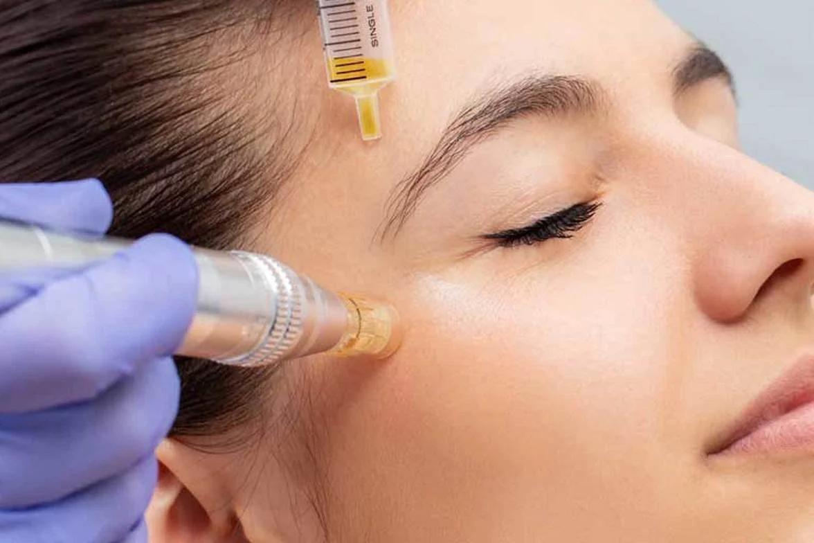 PRP Microneedling (vampire facial)
