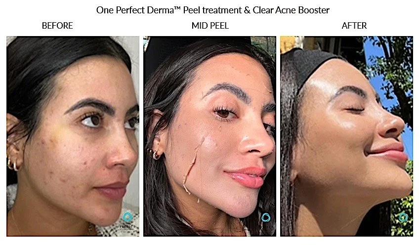 Perfect-derma-peel_051-1.jpg