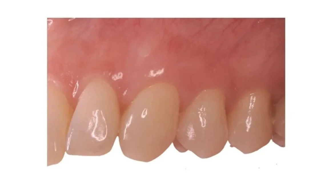 Mucogingival therapy.