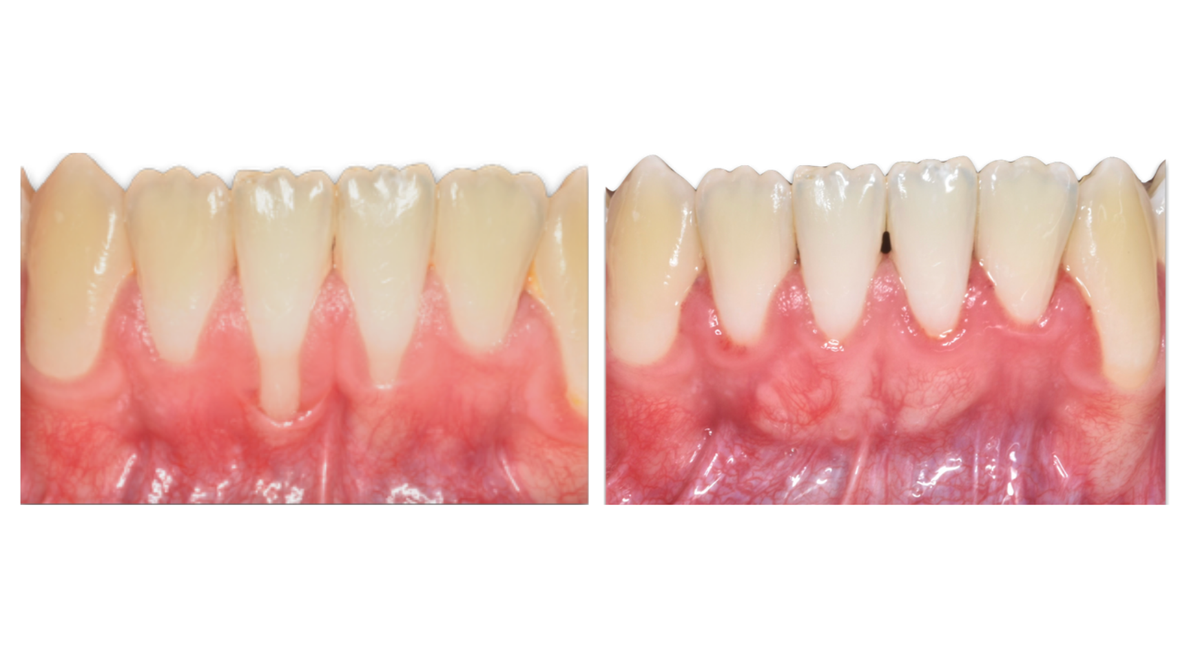 Free gingival graft.