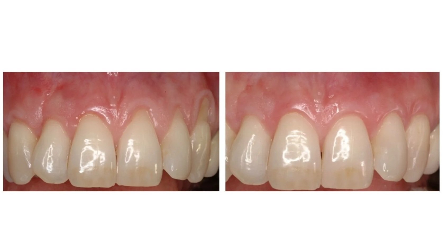 Soft Tissue Management in the Aesthetic Zone
