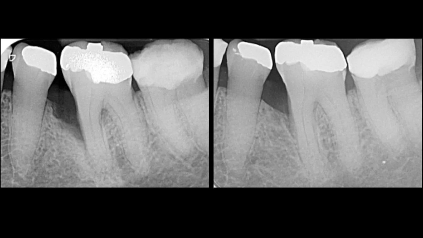 Periodontal regeneration