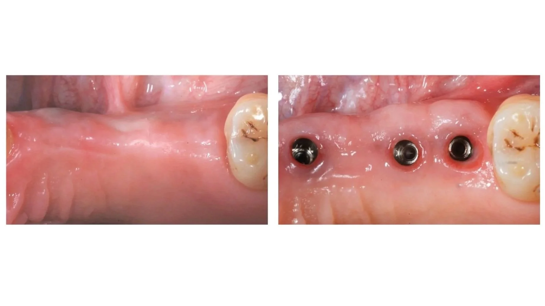 Techniques for Edentulous Ridge Augmentation