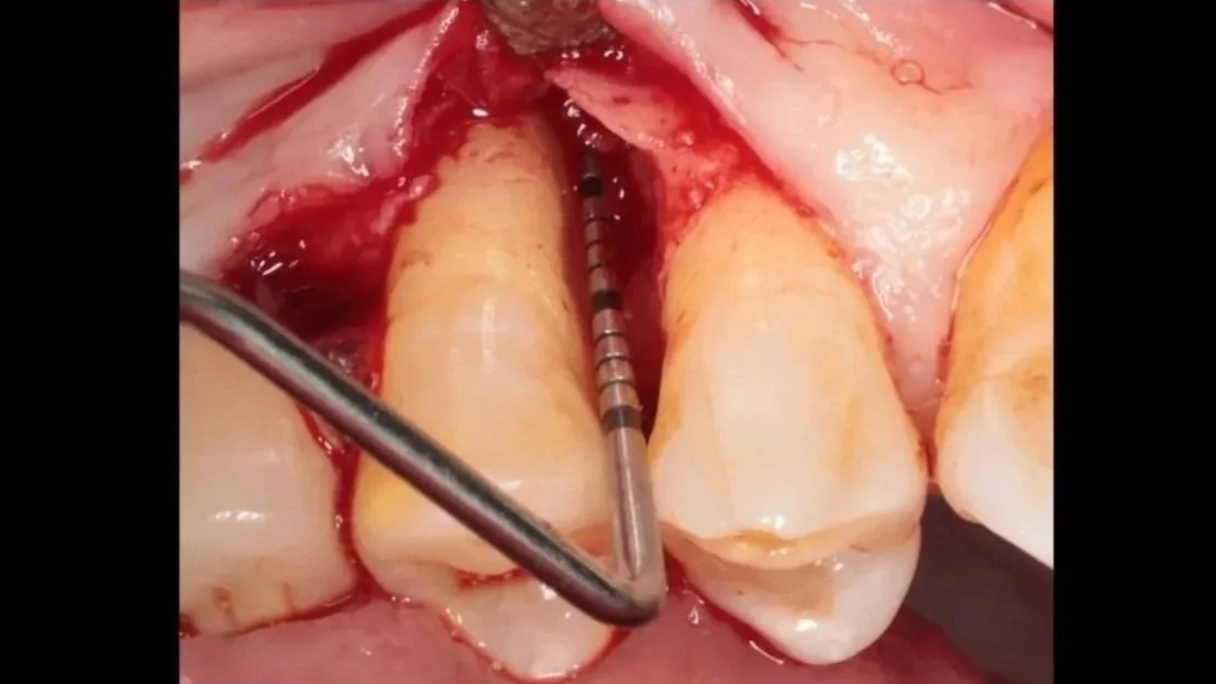 Periodontal infrabony defect