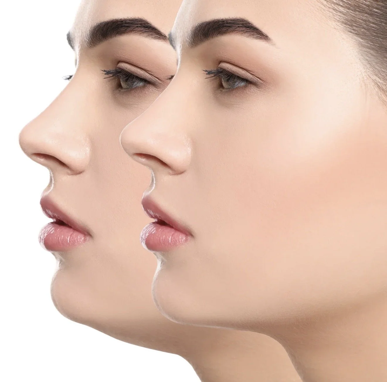 Side profile of a woman's face before and after under chin fat dissolving procedure, showing reduction in under chin fat.