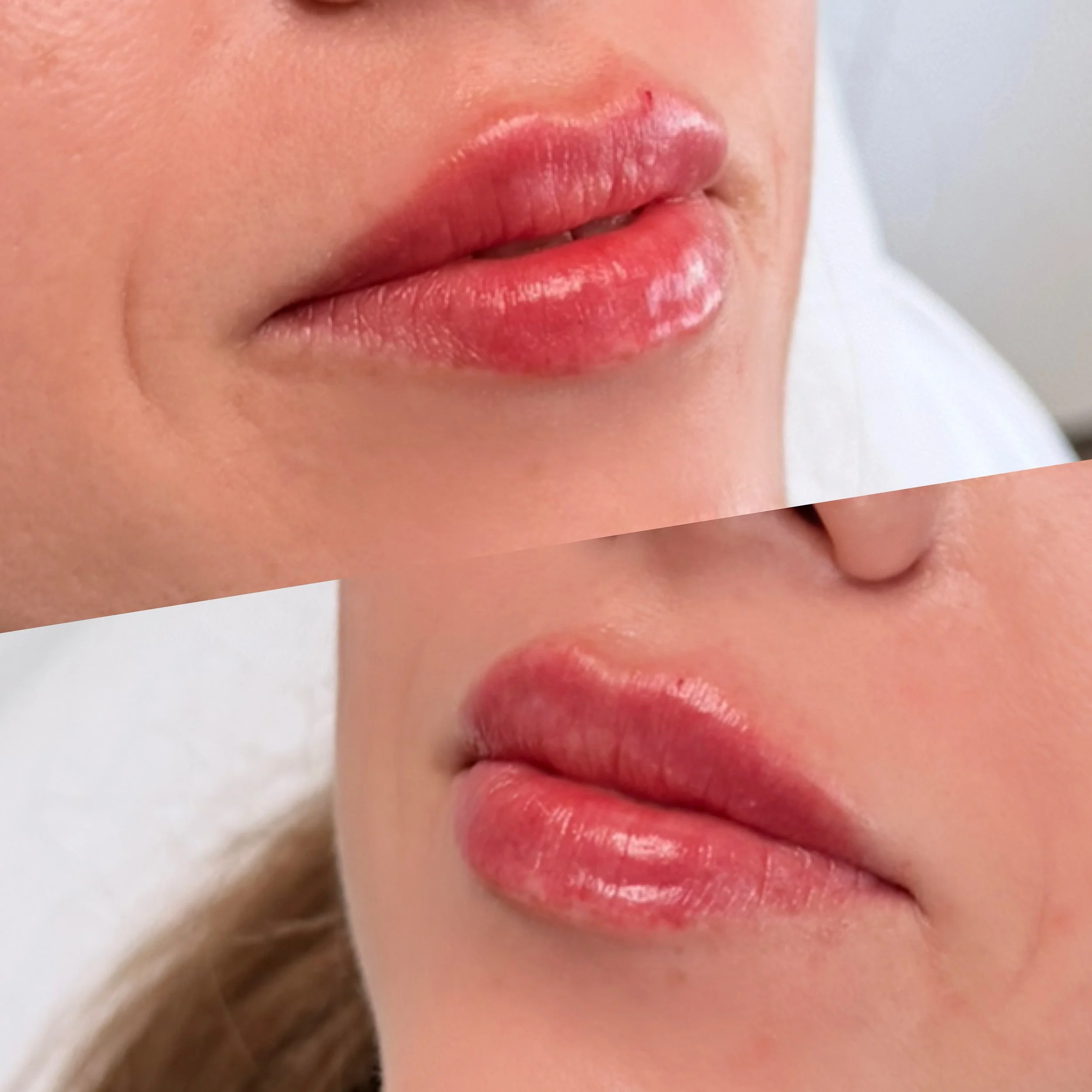 Close-up of a woman's lips after lip filler , showing both upper and lower lips from two different angles.