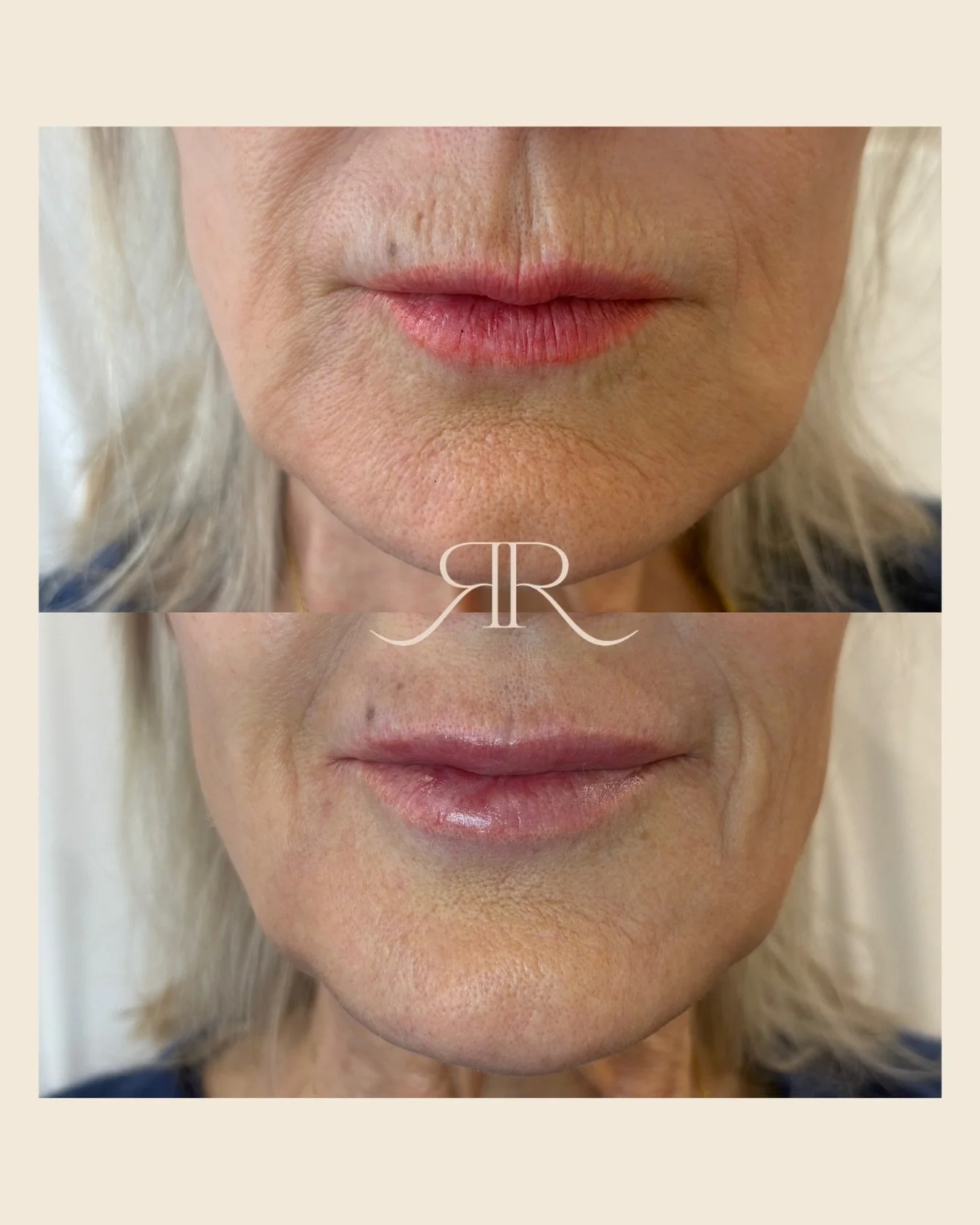 60 minutes later, 10 years younger🤍

Such a pleasure to do this job &amp; make my patients look as fresh as they feel🫶🏻

#nurseinjectors #juvedermlips #therejuvenationroomswindsor #naturallipfiller