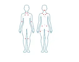 La fibromialgia se caracteriza por dolores generalizados y sintomas ansioso-depresivos