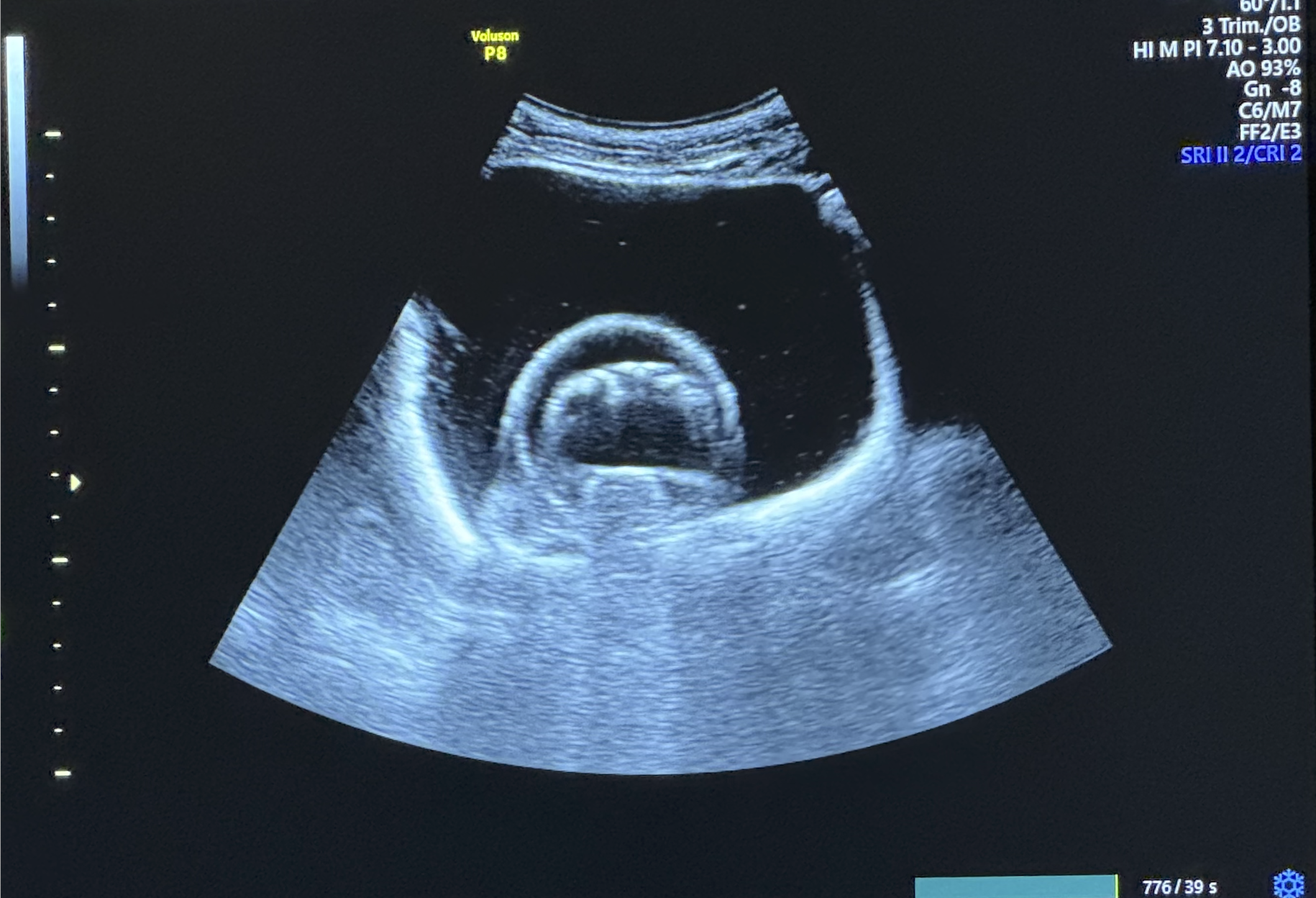 Rubin model ultrasound 