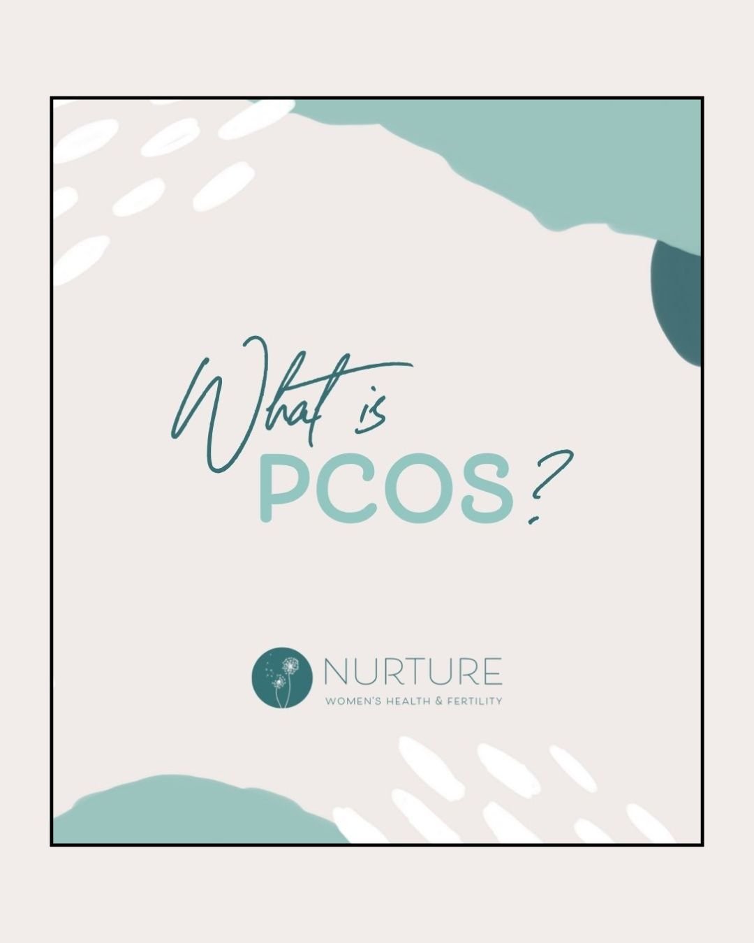 PCOS, or Polycystic Ovary Syndrome, is a hormonal disorder affecting women of reproductive age, characterized by irregular menstrual cycles, elevated levels of androgens (male hormones), and often multiple small cysts on the ovaries. It can lead to s