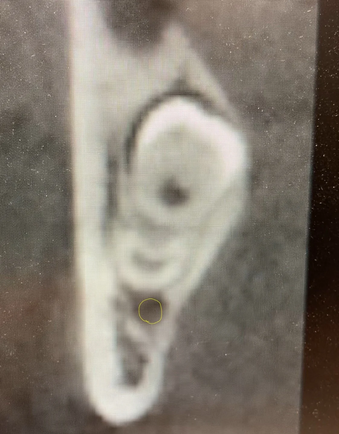 A coronal slice of a Dental CBCT image of a mandibular third molar. The IAN is outlined in yellow to show a circular shape. No nerve compression noted, just intimate with the root of the tooth.