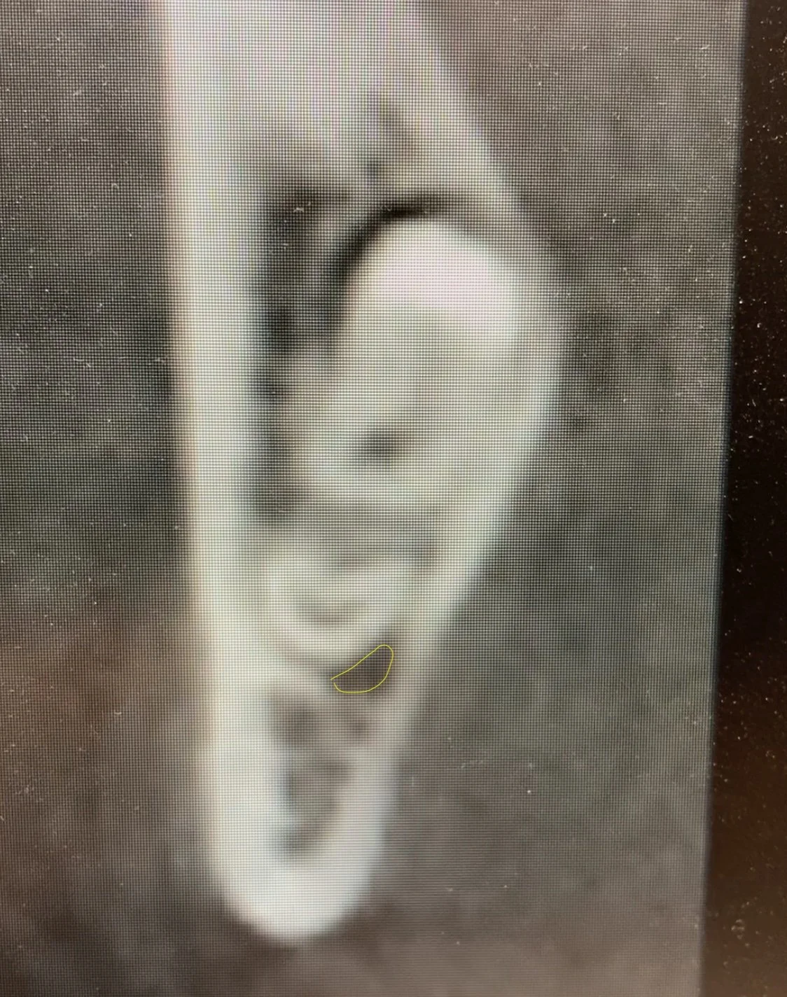 A coronal slice of a Dental CBCT image of a mandibular third molar. The IAN is outlined in yellow to show a kidney bean shape, moderate nerve compression.