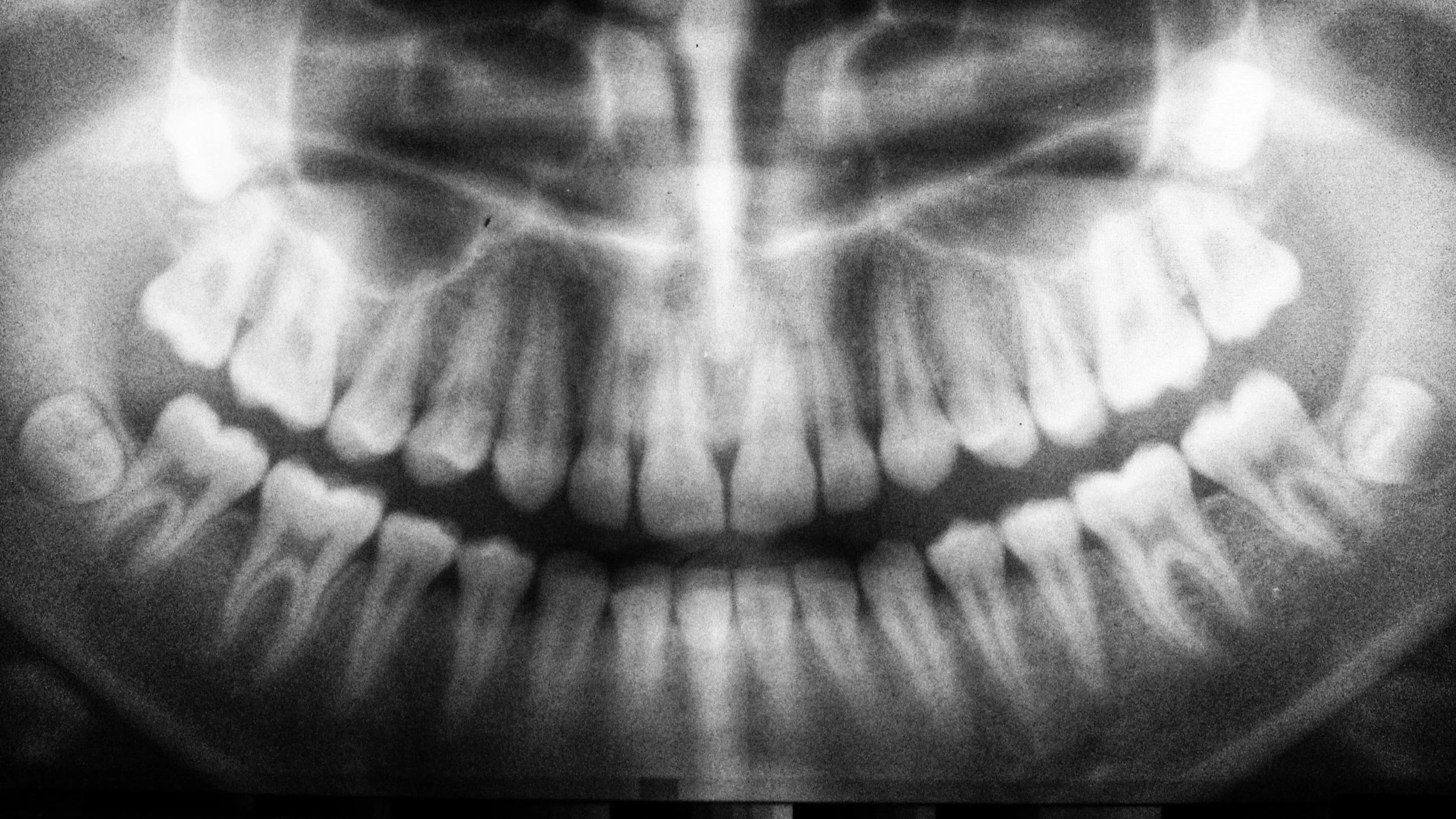 A black and white dental X-ray known as a panoramic view, showing a frontal view of upper and lower teeth and jaw as well as impacted wisdom teeth.
