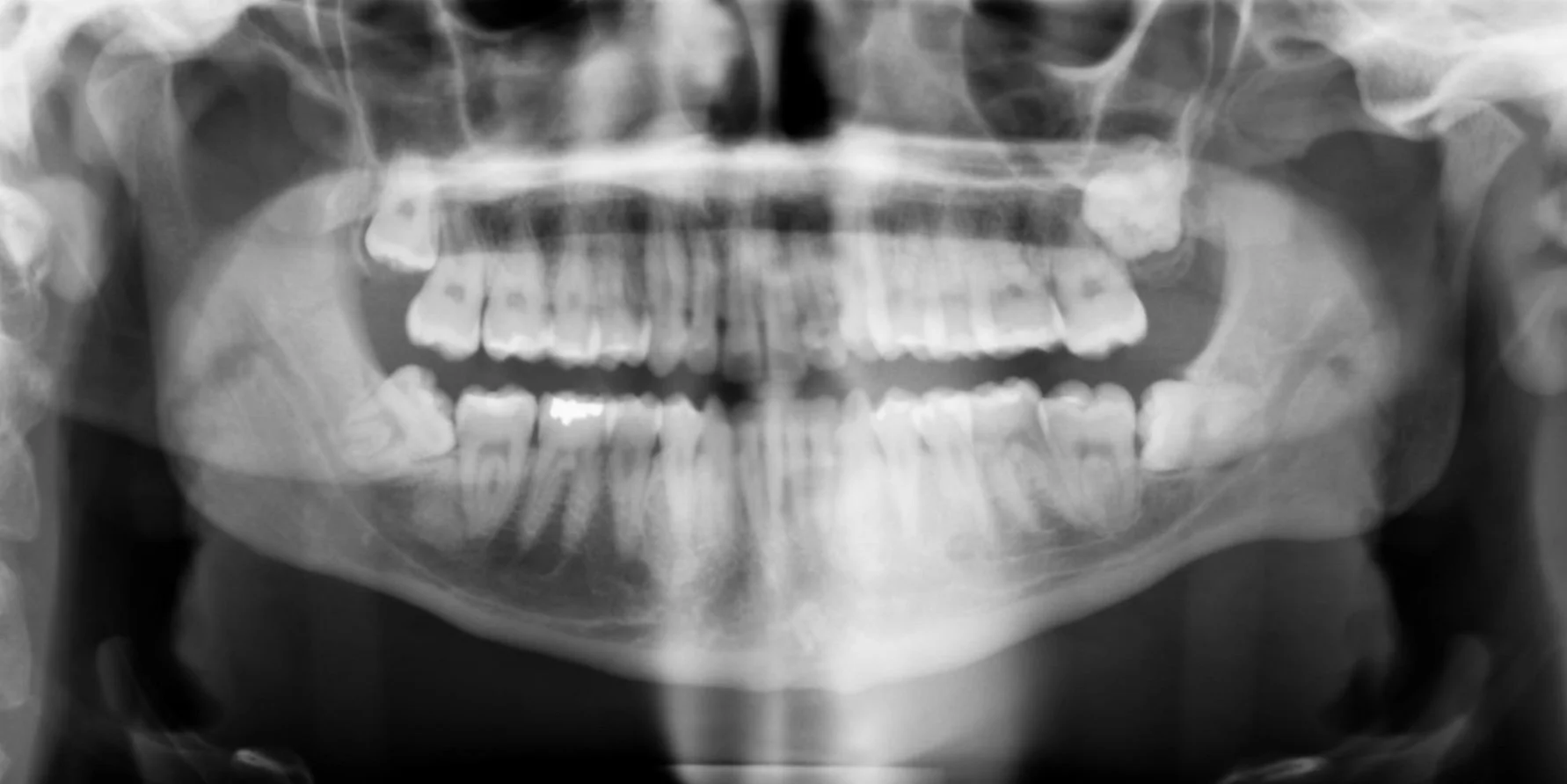 Black and white X-ray image of a human skull showing teeth and jaw bones. Highlighting impacted tooth #1,16,17,32.