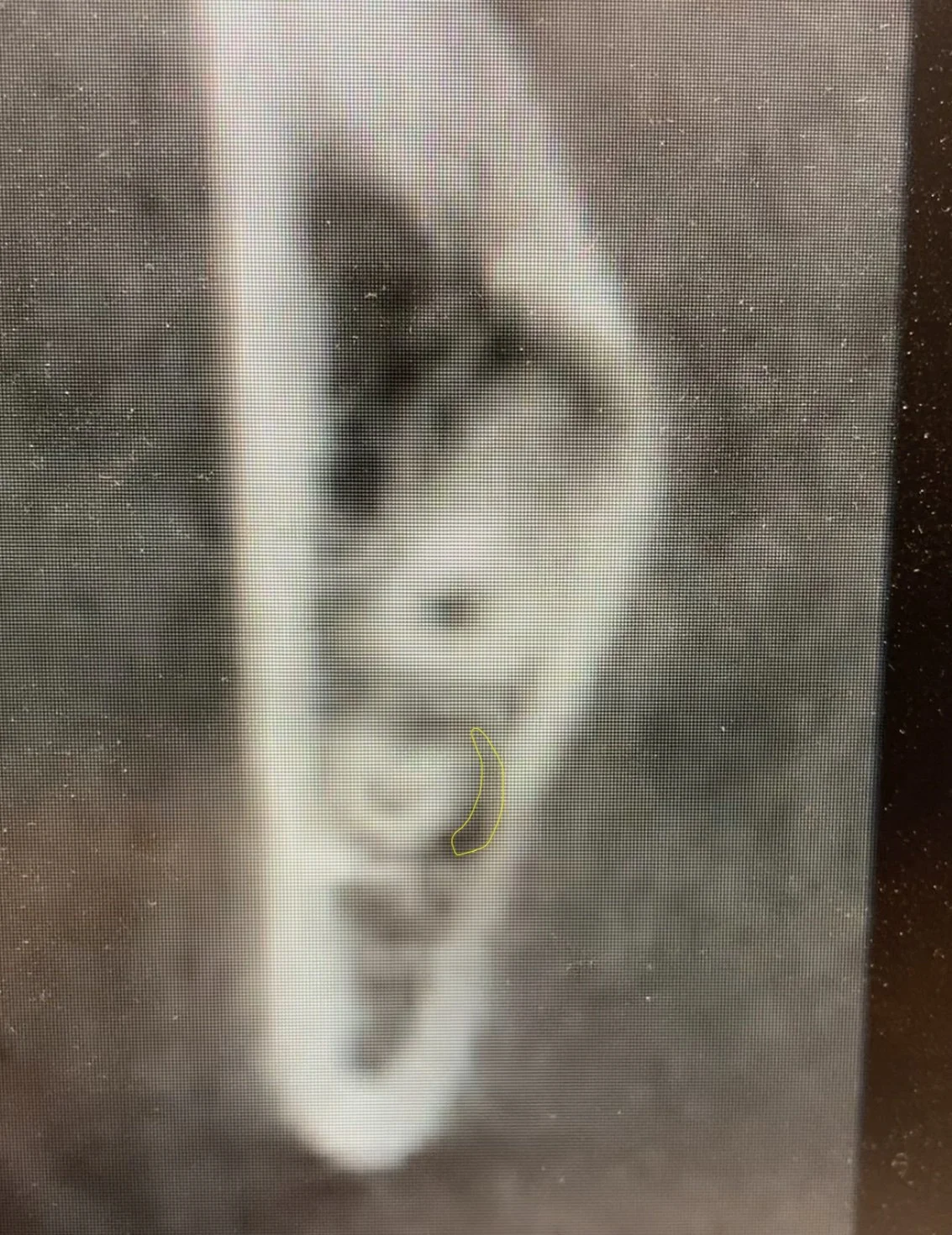 A coronal slice of a Dental CBCT image of a mandibular third molar. The IAN is outlined in yellow to show a severely compressed nerve.