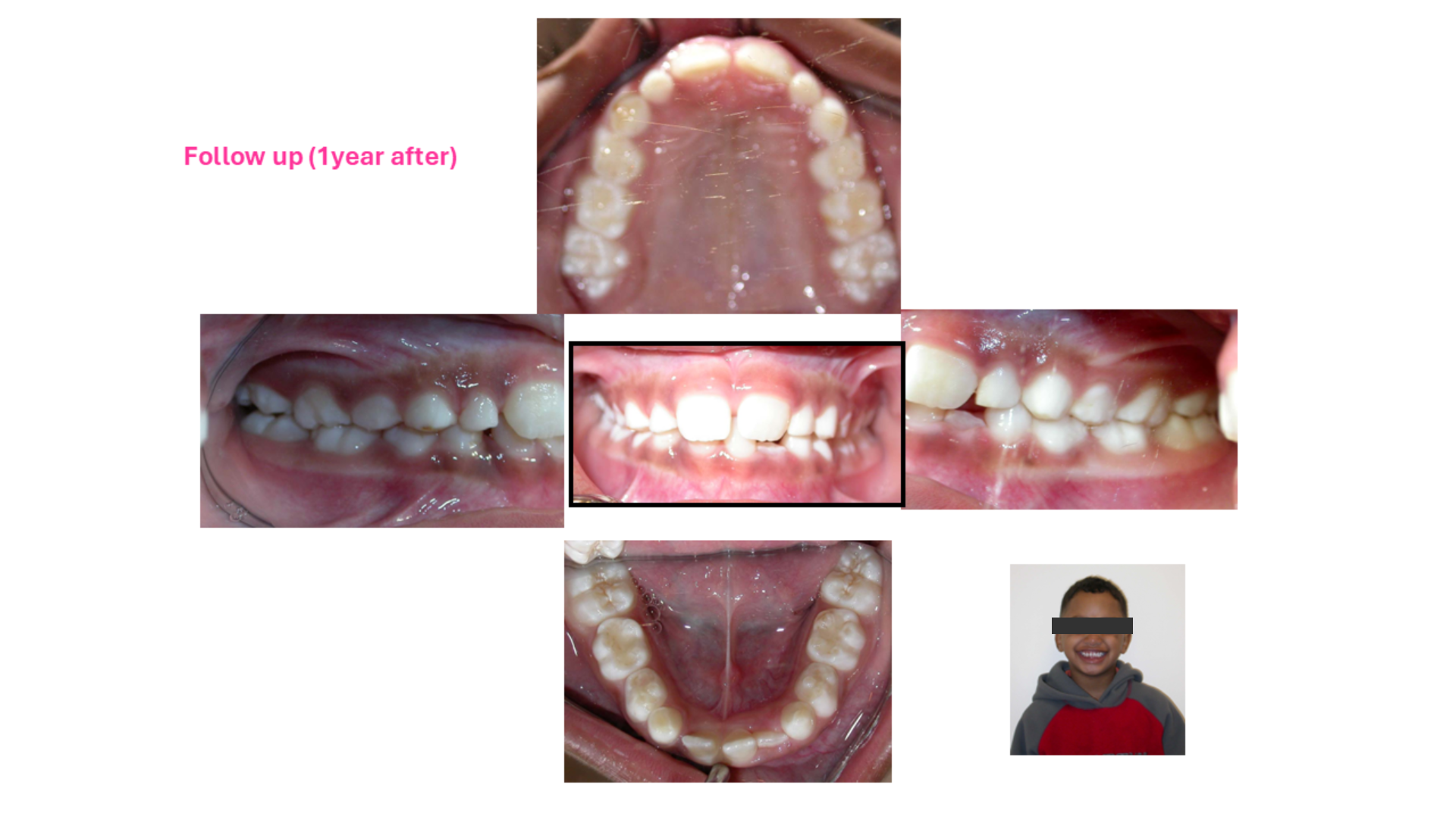 functional orthodontia results.png