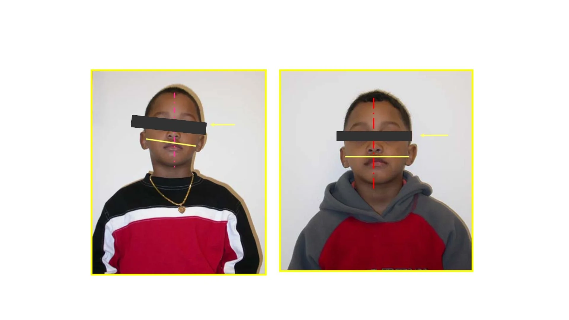 functional orthodontia results (1).jpg