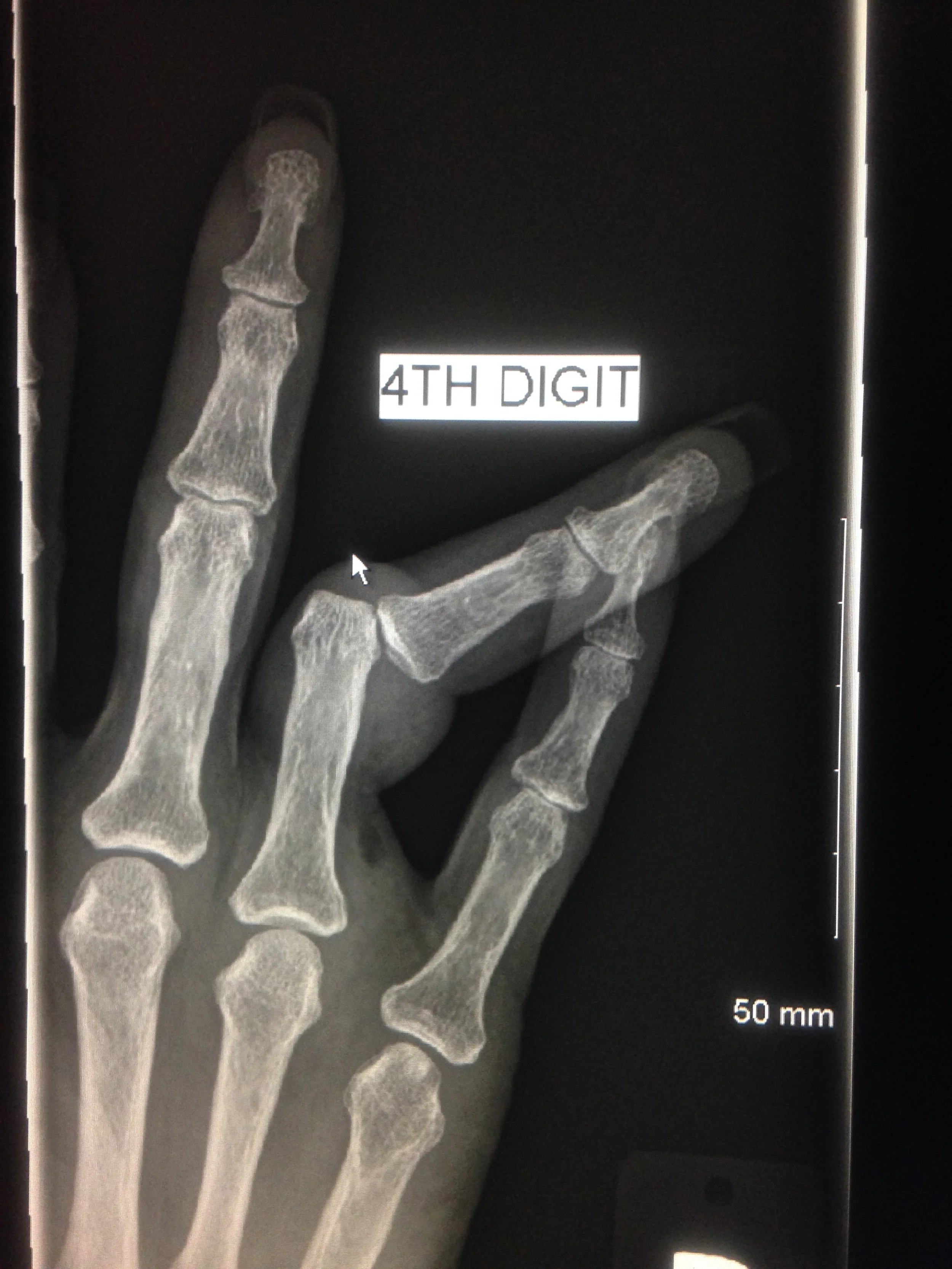 X-ray image of a human hand showing the finger bones, with a label indicating the fourth digit.
