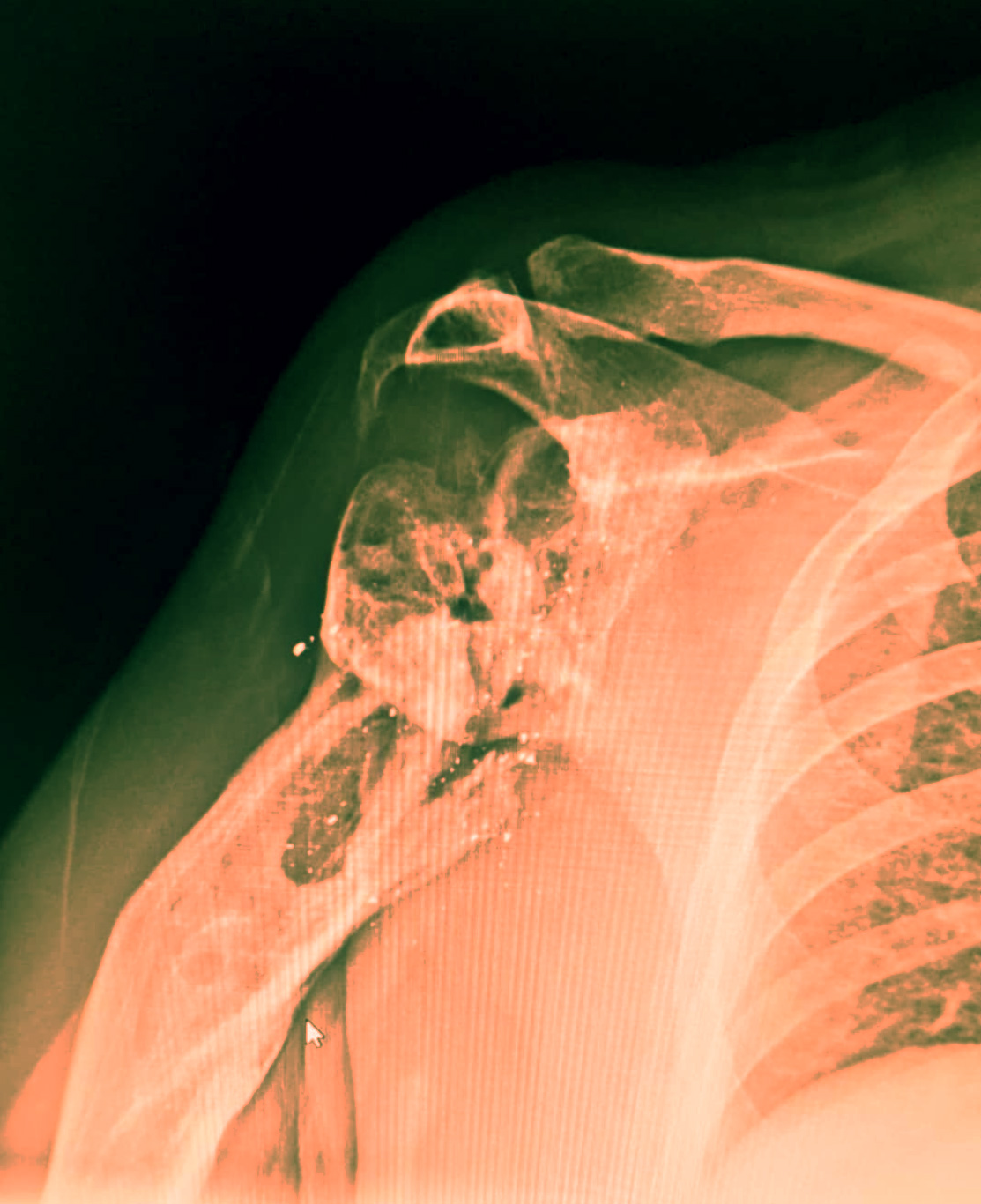 X-ray image of a human shoulder with visible bones and joints.